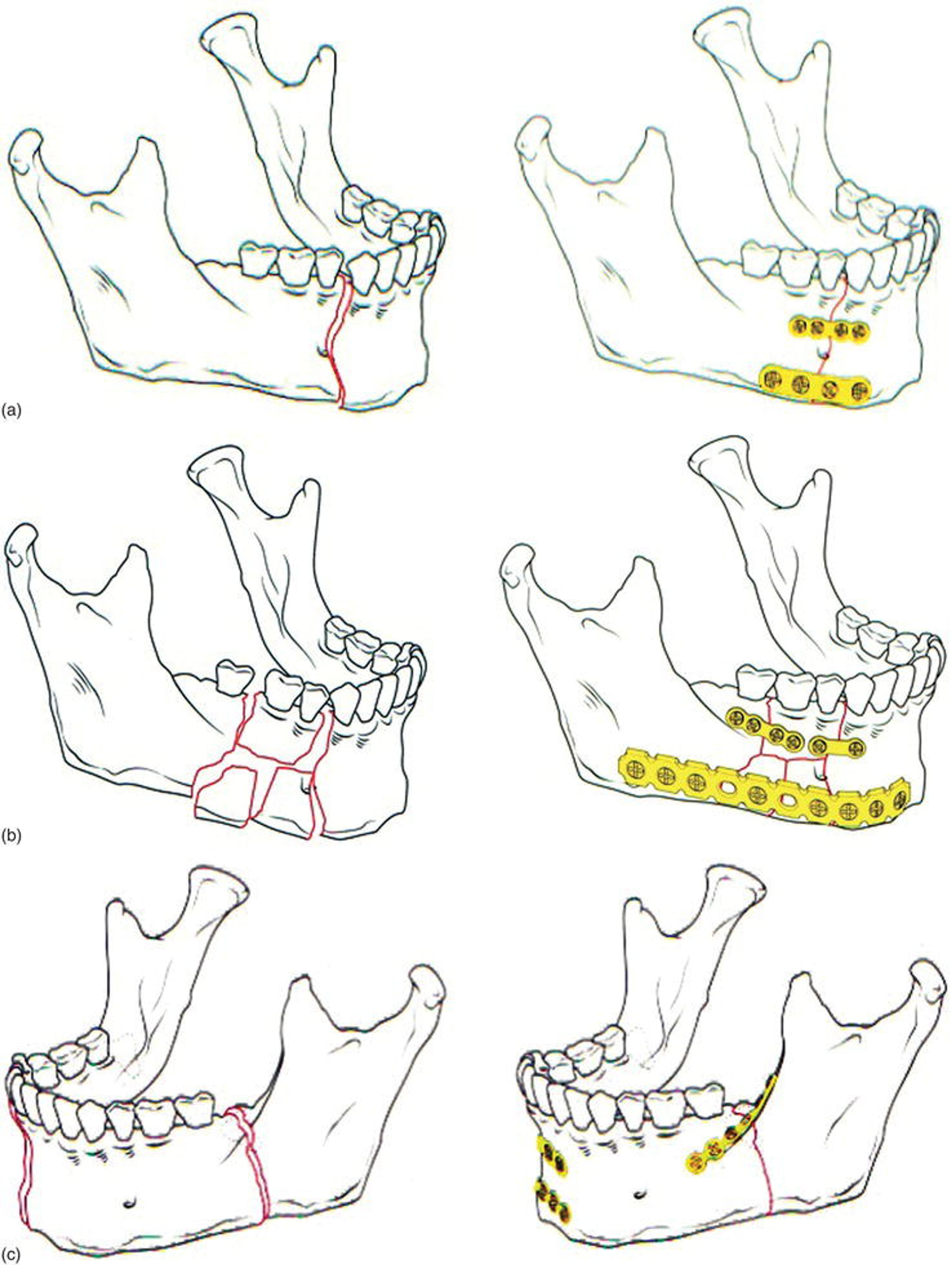 Principles of rigid internal fixation of the mandible. (a) Load‐sharing fixation, with linear fracture of the right parasymphysis (left); stability is provided by a fixation system in conjunction with stabilizing forces provided by anatomic abutment of noncomminuted fracture segments (right). Fixation is applied to the inferior border (zone of compression) and superior border (zone of tension). (b) Load‐bearing fixation, with comminuted fracture of the right mandibular body (left); functional stability is provided solely by the fixation system (right). Contemporary fixation systems involve 2.3‐ or 2.4‐mm locking reconstruction plate at inferior border combined with secondary fixation of comminuted segments at the superior border. (c) Functional stabilization along Champy’s ideal lines of osteosynthesis. Fractures located proximal to the first premolar may be safely stabilized with a single miniplate placed in the midbody position (2.0 mm). Fractures anterior to the first premolar should be stabilized with two plates (a tension band and compression band) separated by 4–5 mm and generally placed on either side of the mental nerve. (Source: Prein [71] ) .