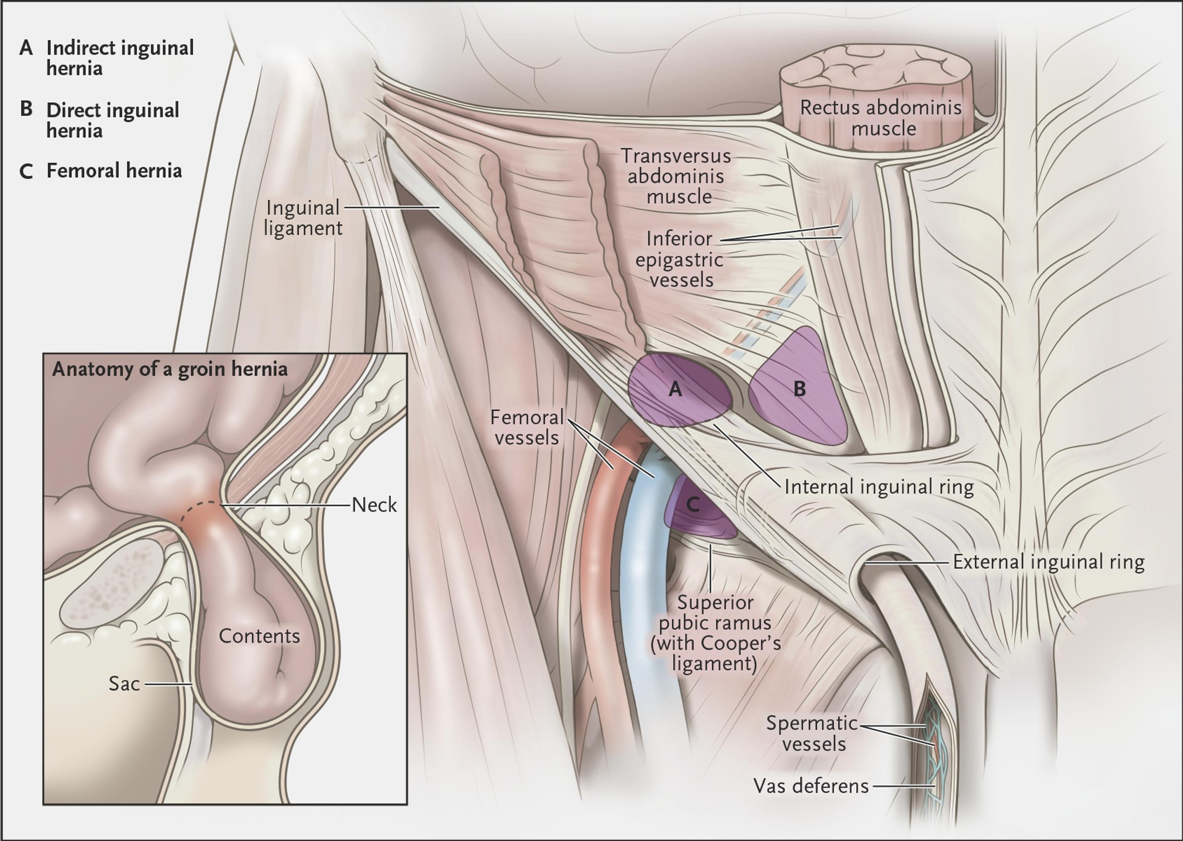 Types of Hernia and Hernia Anatomy from an Anterior Perspective.