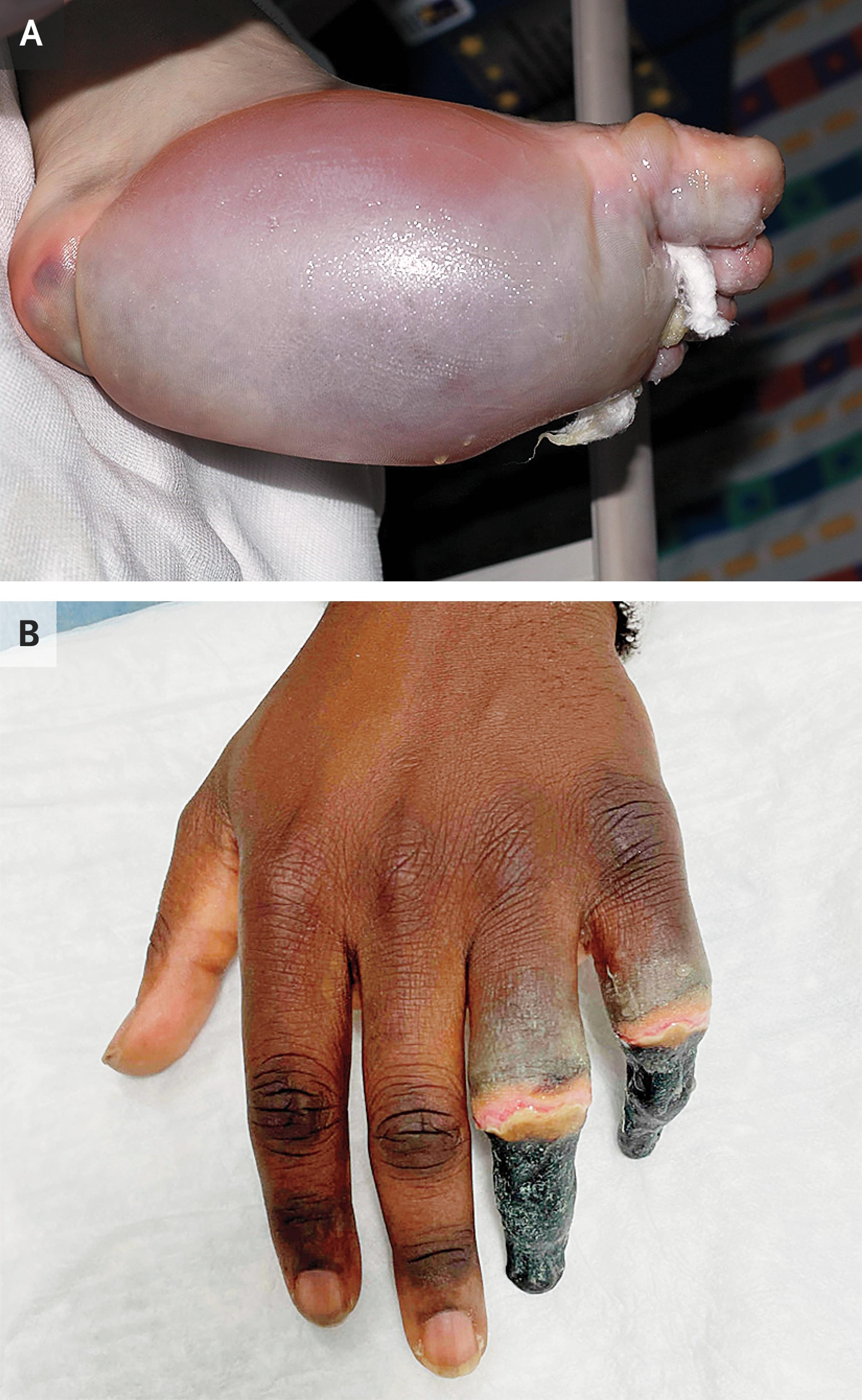 Clinical Images of Frostbite Injury.