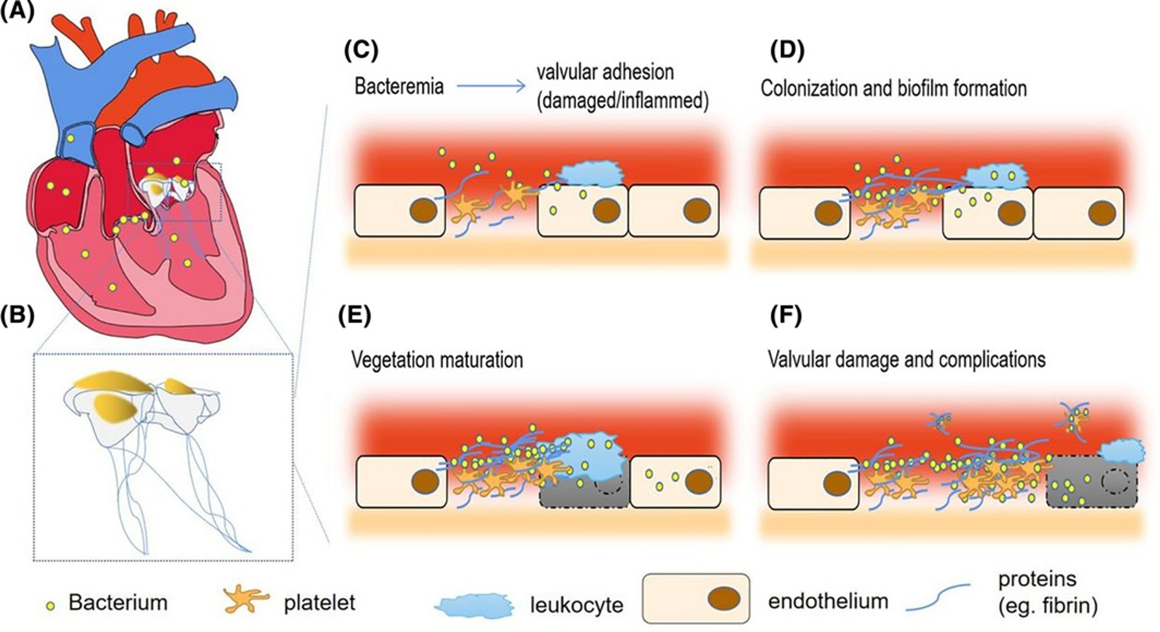 Pathogenesis of infective endocarditis (IE) and its complications.