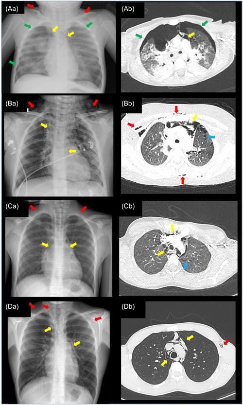 Radiological findings in the four children diagnosed with pneumomediastinum during a SARS‐CoV‐2 infection.
