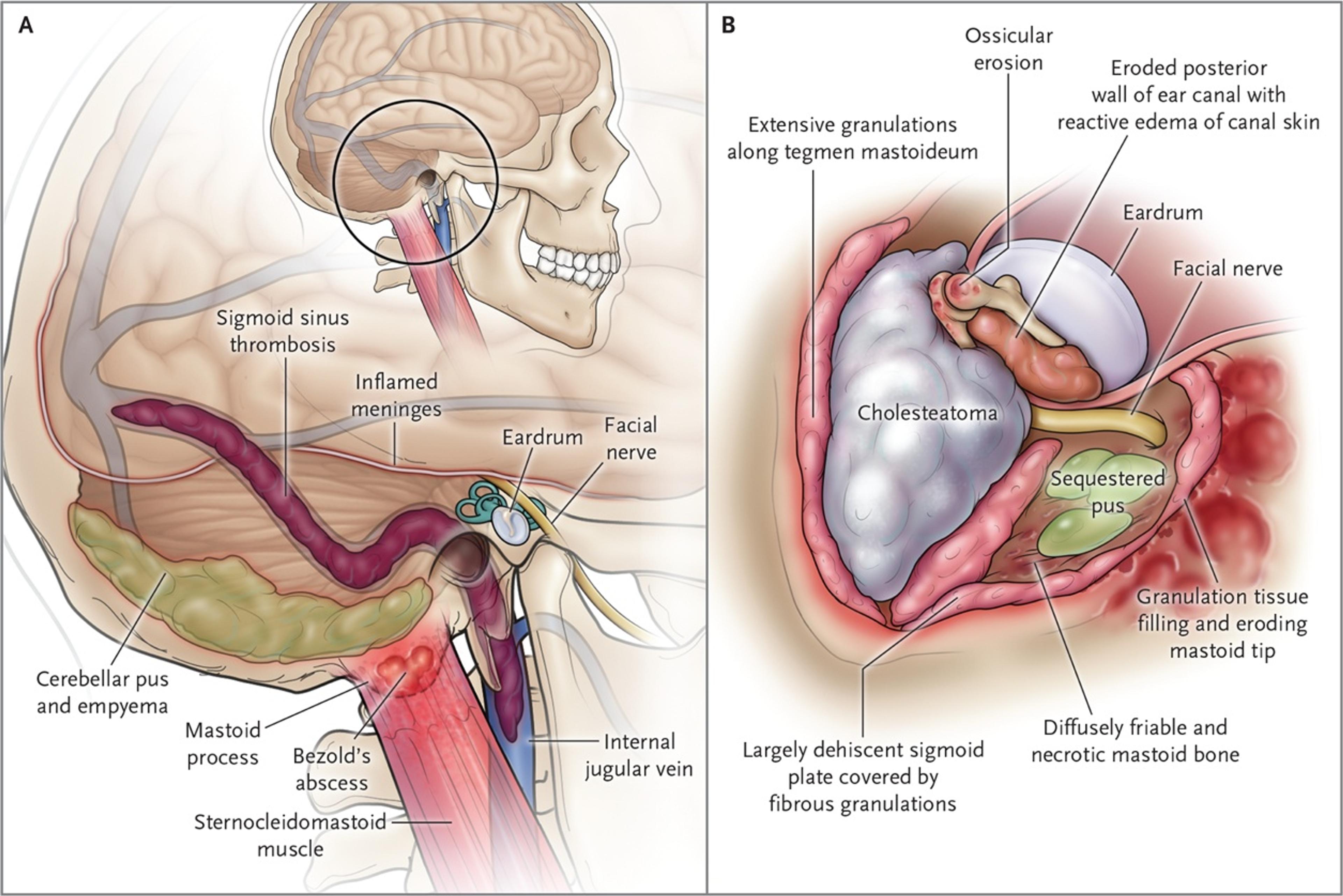 Schematic Representations of the Spread of Infection from Otitis Media (Panel A) and Operative Findings (Panel B).