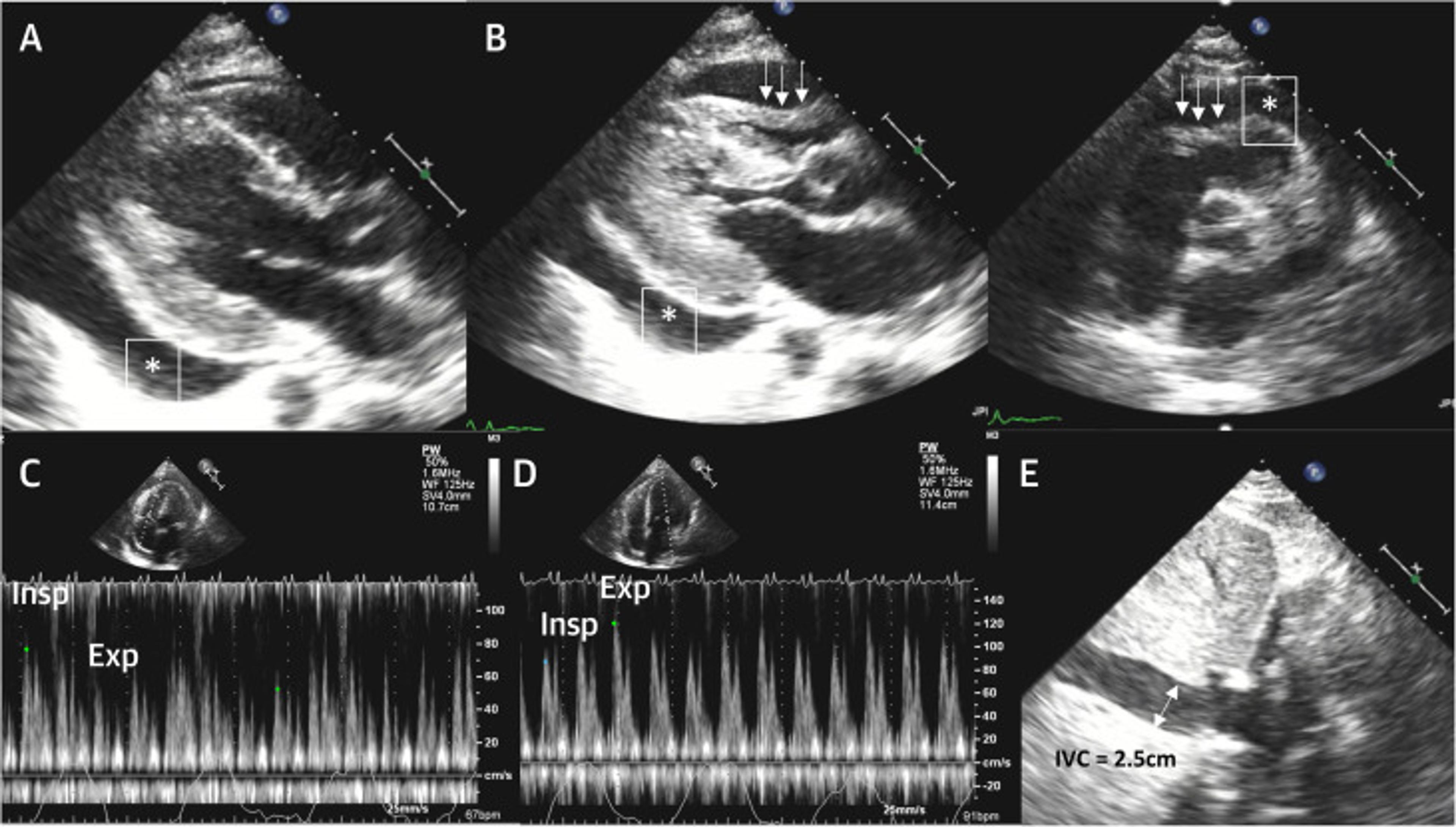 TTE Signs of CTP