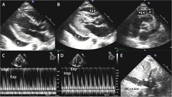 TTE Signs of CTP