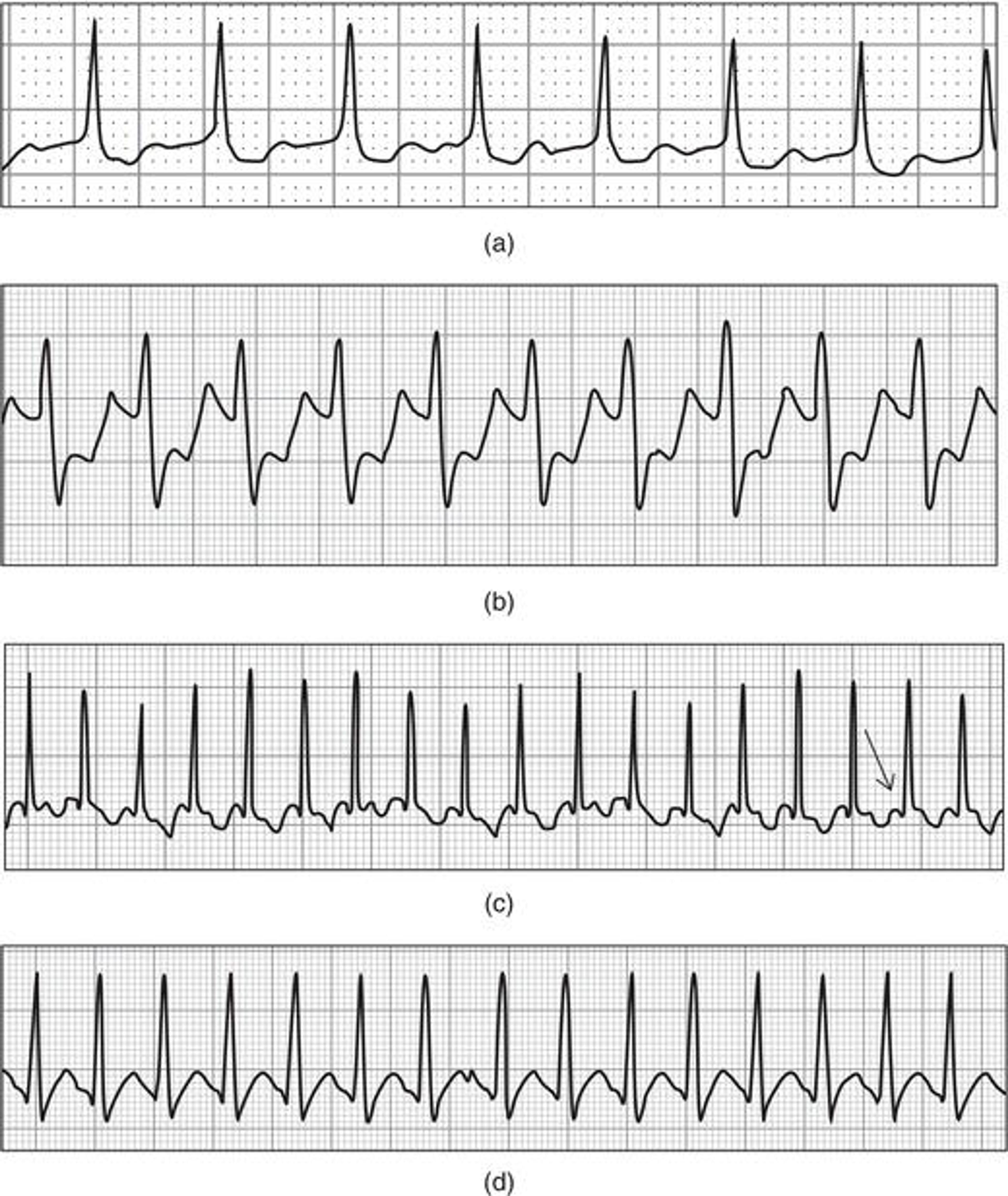 Paroxysmal supraventricular tachycardia ( PSVT ). (a) PSVT with a relatively slower rate of approximately 150 bpm. (b) PSVT at approximately 170 bpm; the ST segment depression is likely a rate‐related phenomenon and not indicative of coronary ischemia. (c) PSVT in a neonate with an approximate rate of 260 bpm; note the retrograde P wave (arrow) preceding the QRS complex. (d) PSVT in the Wolff–Parkinson–White syndrome. Other than a more rapid rate, this form of PSVT is indistinguishable from non‐WPW‐related PSVT.