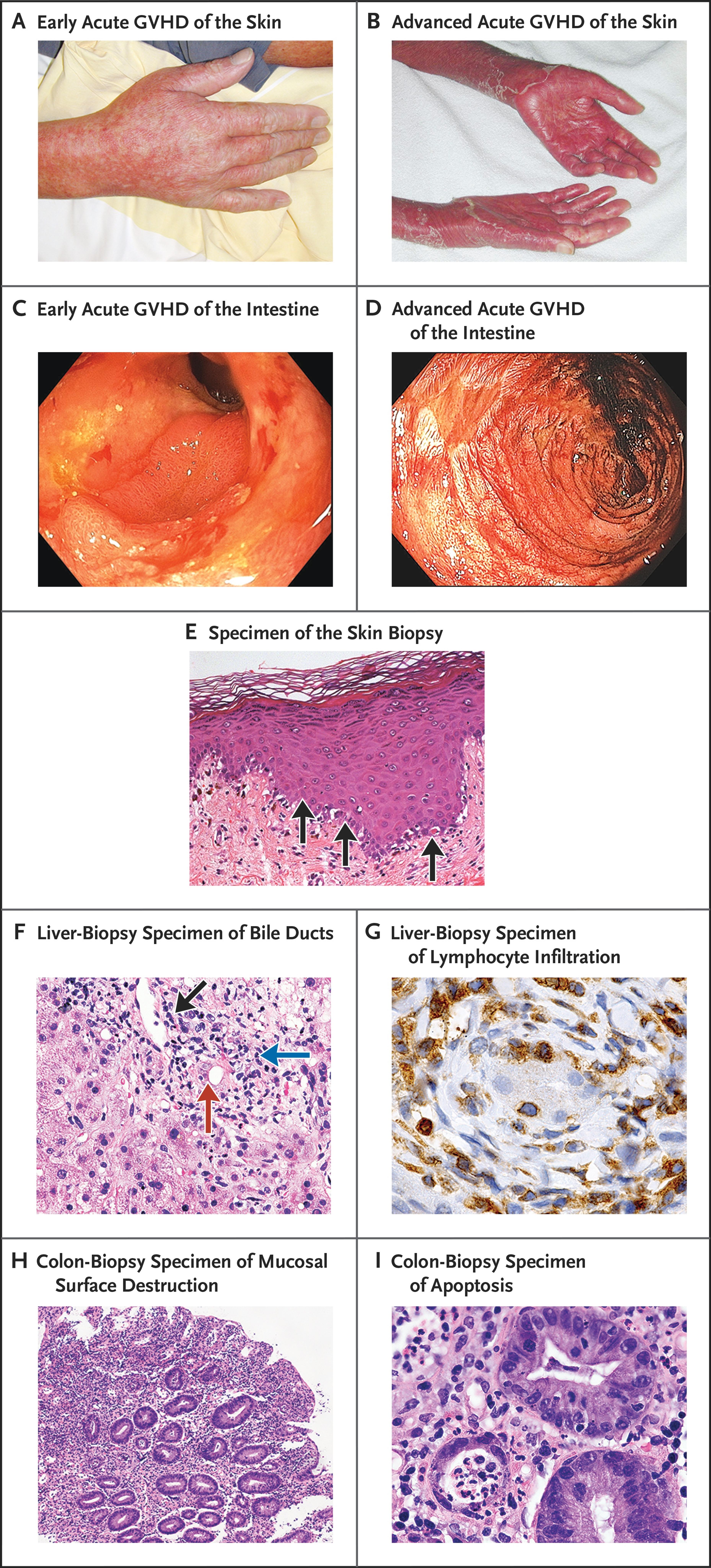 Clinical Features of Acute GVHD.
