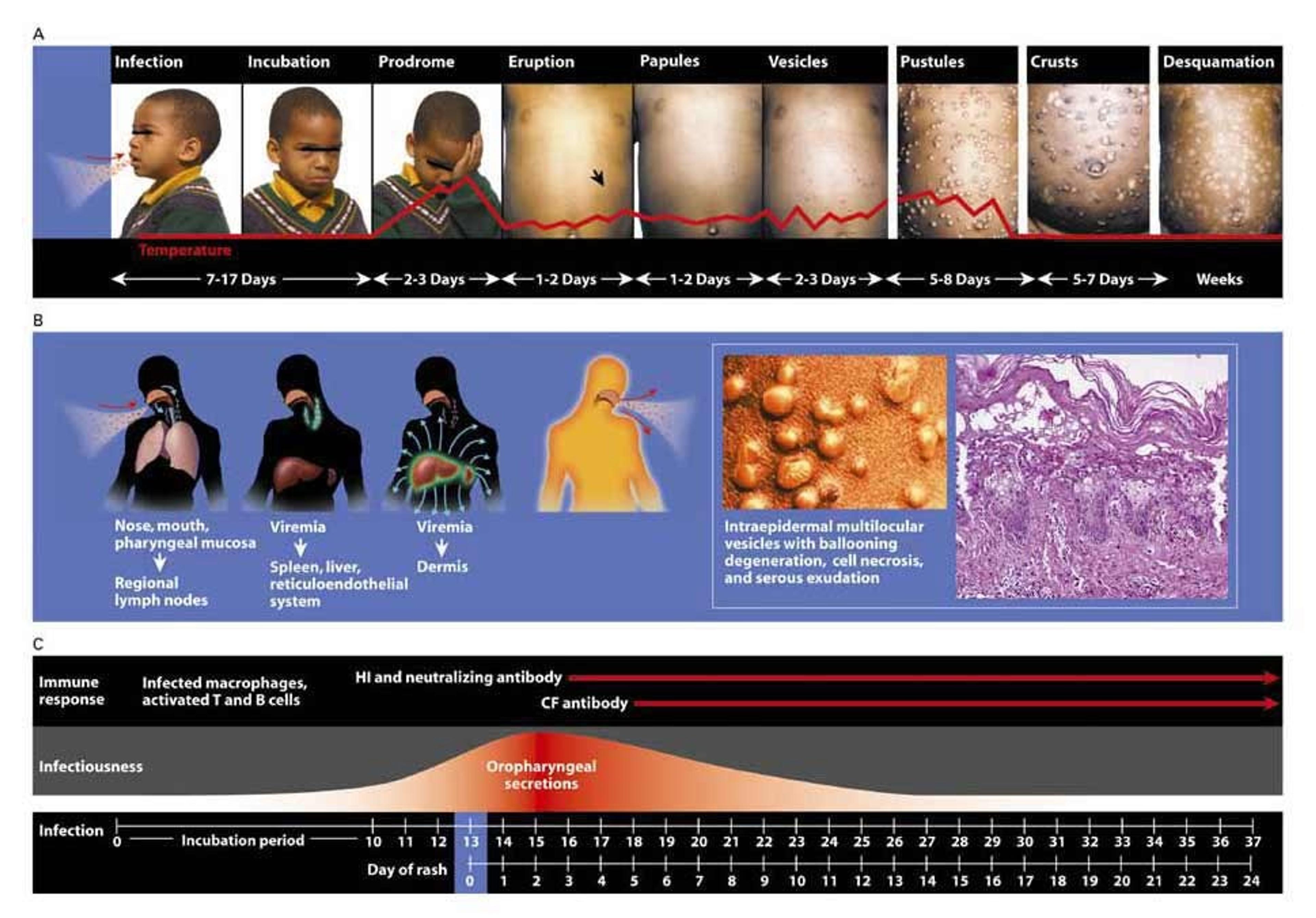 Clinical Manifestations and Pathogenesis of Smallpox and the Immune Response.