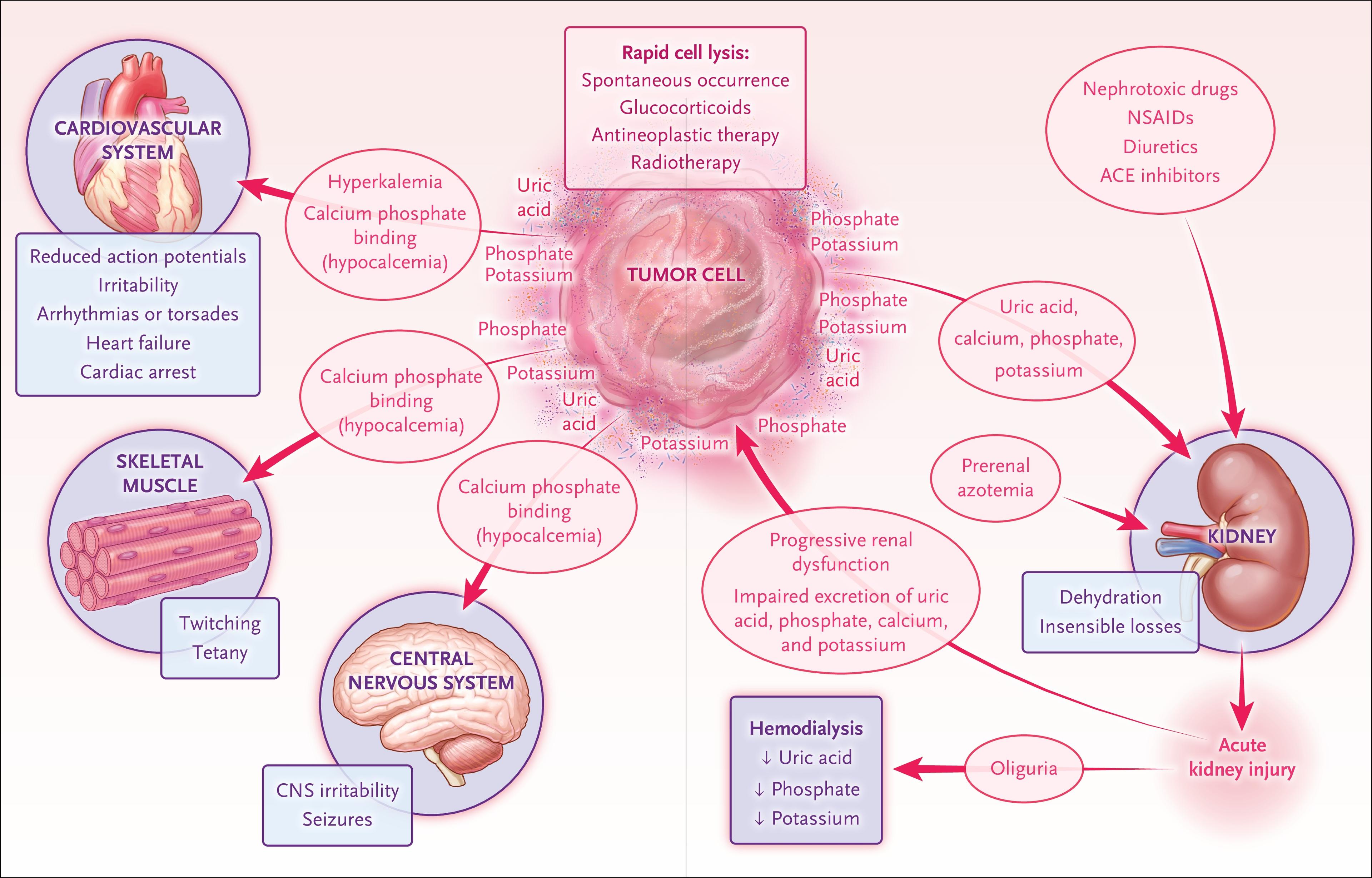 Pathophysiology of Tumor Lysis Syndrome.