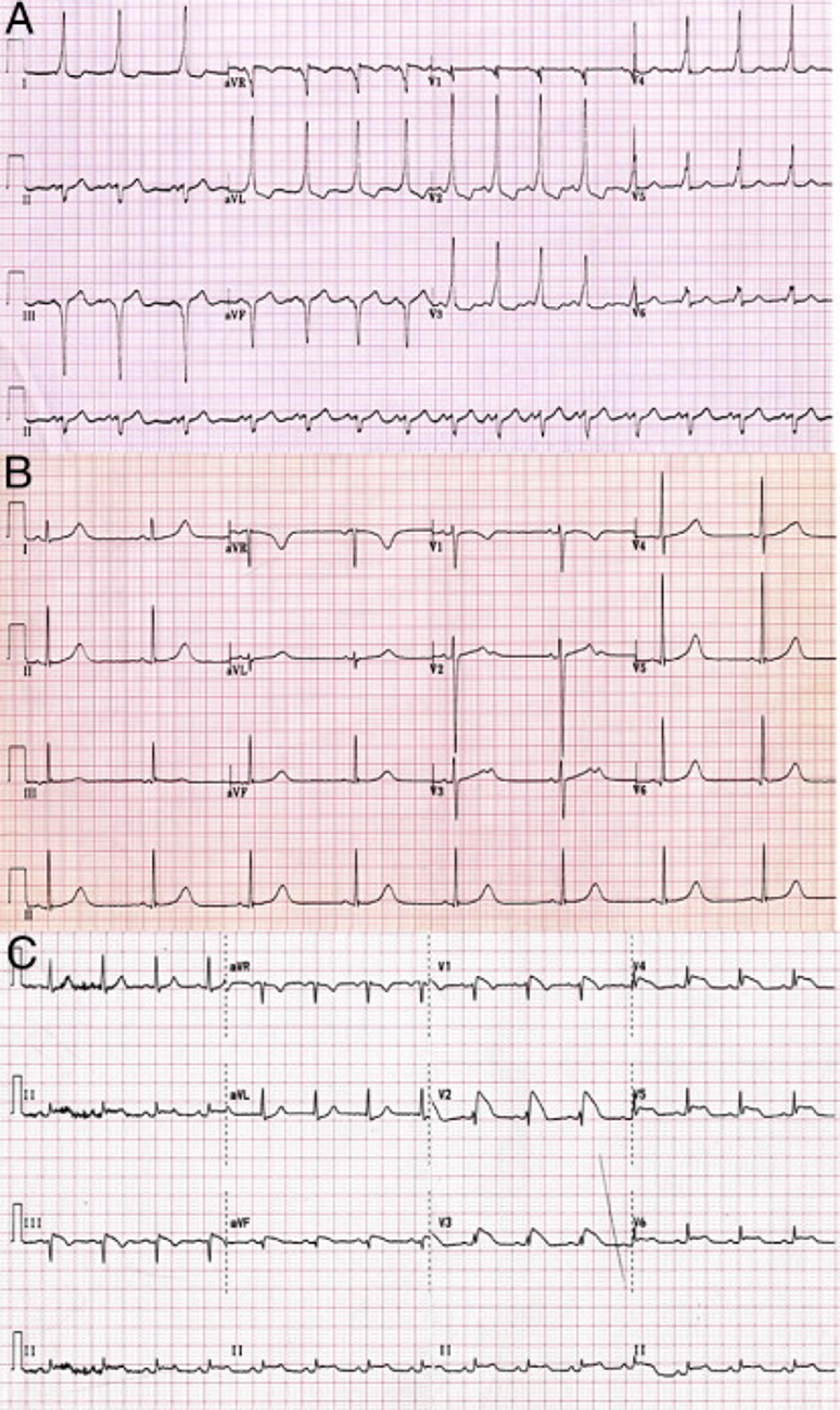 Electrocardiographic Patterns Observed in Electrical Cardiac Abnormalities Associated With Sudden Cardiac Death