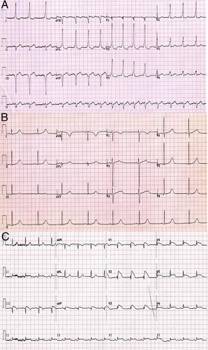 Electrocardiographic Patterns Observed in Electrical Cardiac Abnormalities Associated With Sudden Cardiac Death