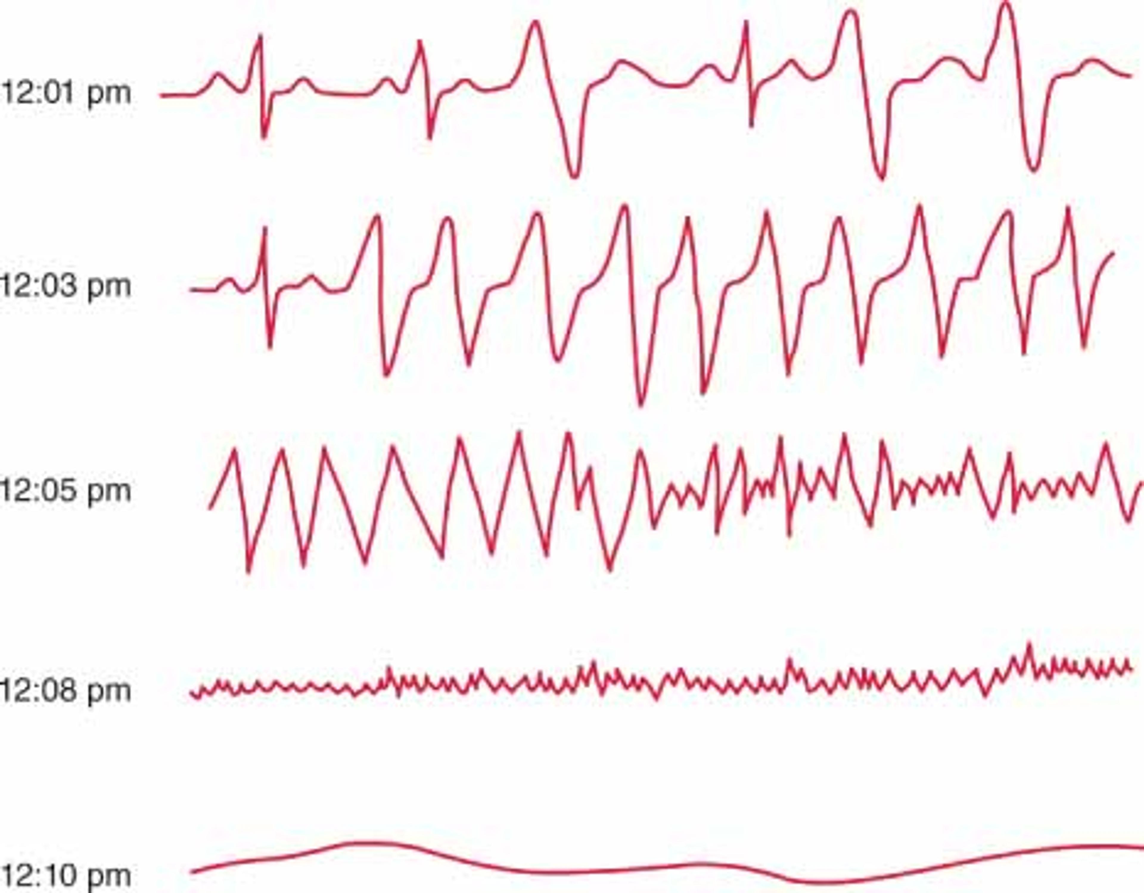 Figure 5. A typical sequence of events in sudden death. This figure shows tracings from a Holter recording made in a patient who experienced sudden death. At 12.01 p.m. the patient is in sinus rhythm with PVCs. At 12.03 p.m. ventricular tachycardia occurs, which degenerates to ventricular fibrillation at 12.05 p.m. By 12.08 p.m., fine ventricular fibrillation is present. All electrical activity has ceased by 12.10 p.m.