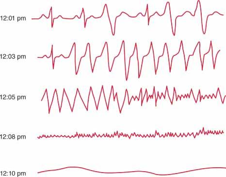 Figure 5. A typical sequence of events in sudden death. This figure shows tracings from a Holter recording made in a patient who experienced sudden death. At 12.01 p.m. the patient is in sinus rhythm with PVCs. At 12.03 p.m. ventricular tachycardia occurs, which degenerates to ventricular fibrillation at 12.05 p.m. By 12.08 p.m., fine ventricular fibrillation is present. All electrical activity has ceased by 12.10 p.m.