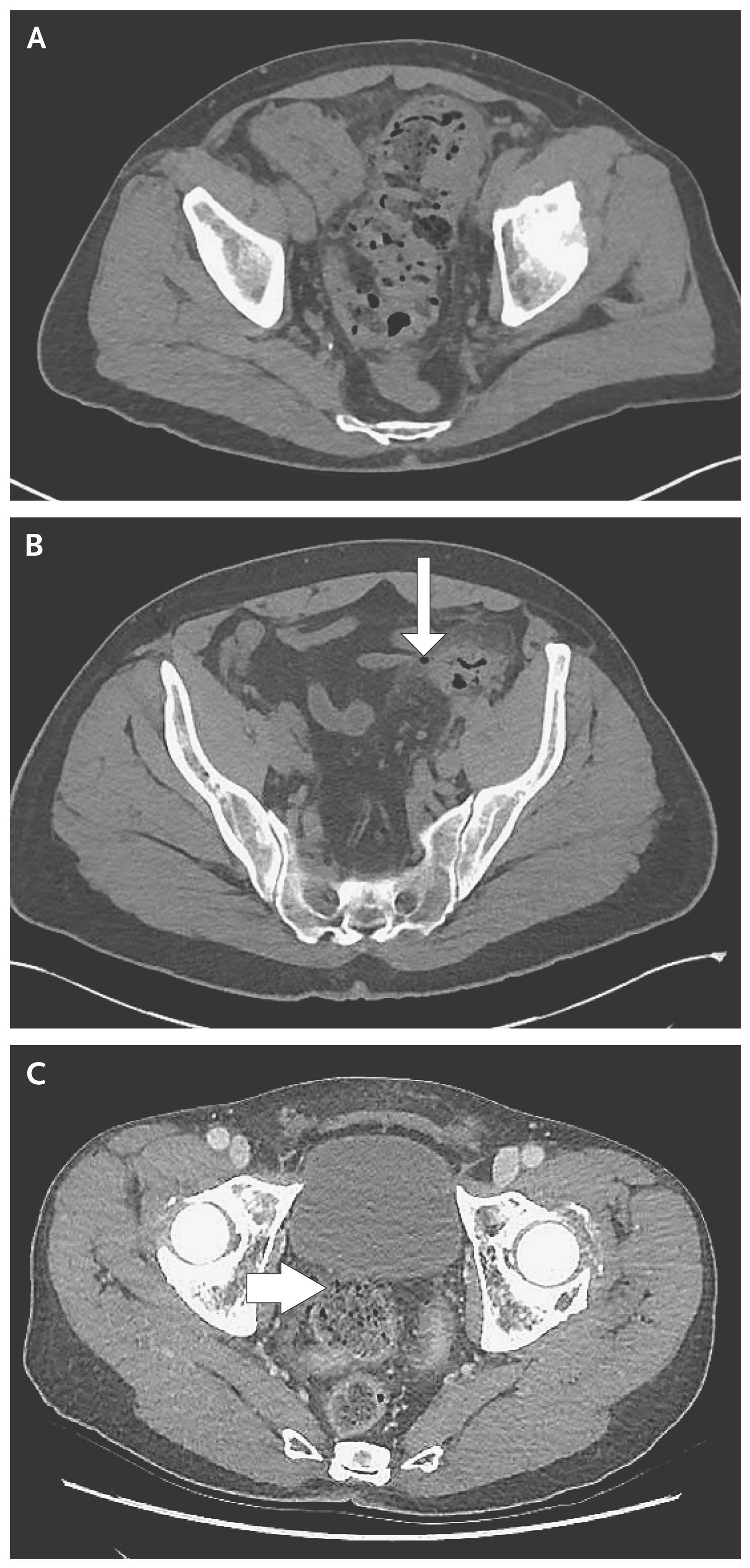 CT Images of the Colon in Patients with Diverticulitis.