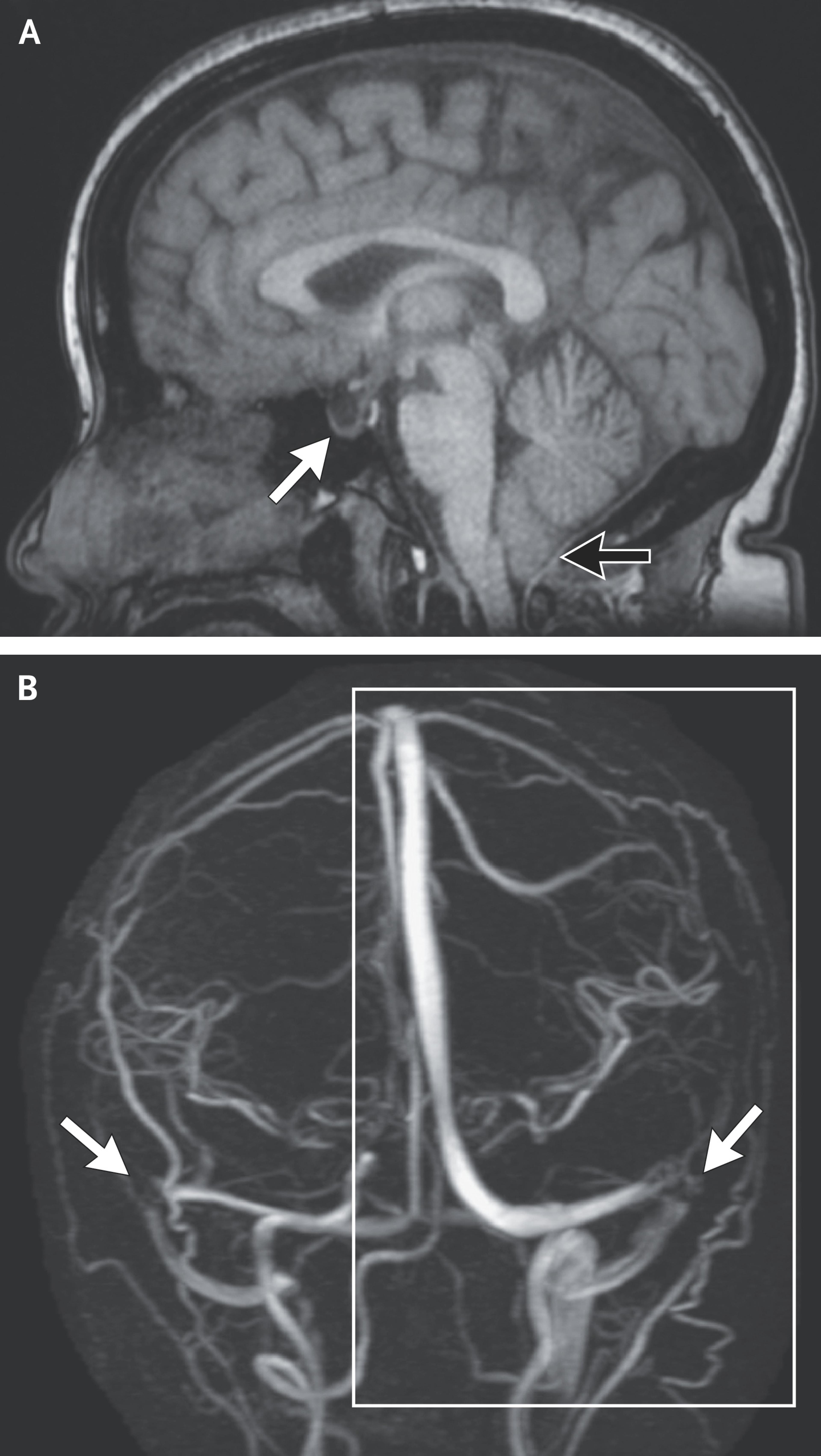 MRI Scans in Idiopathic Intracranial Hypertension.