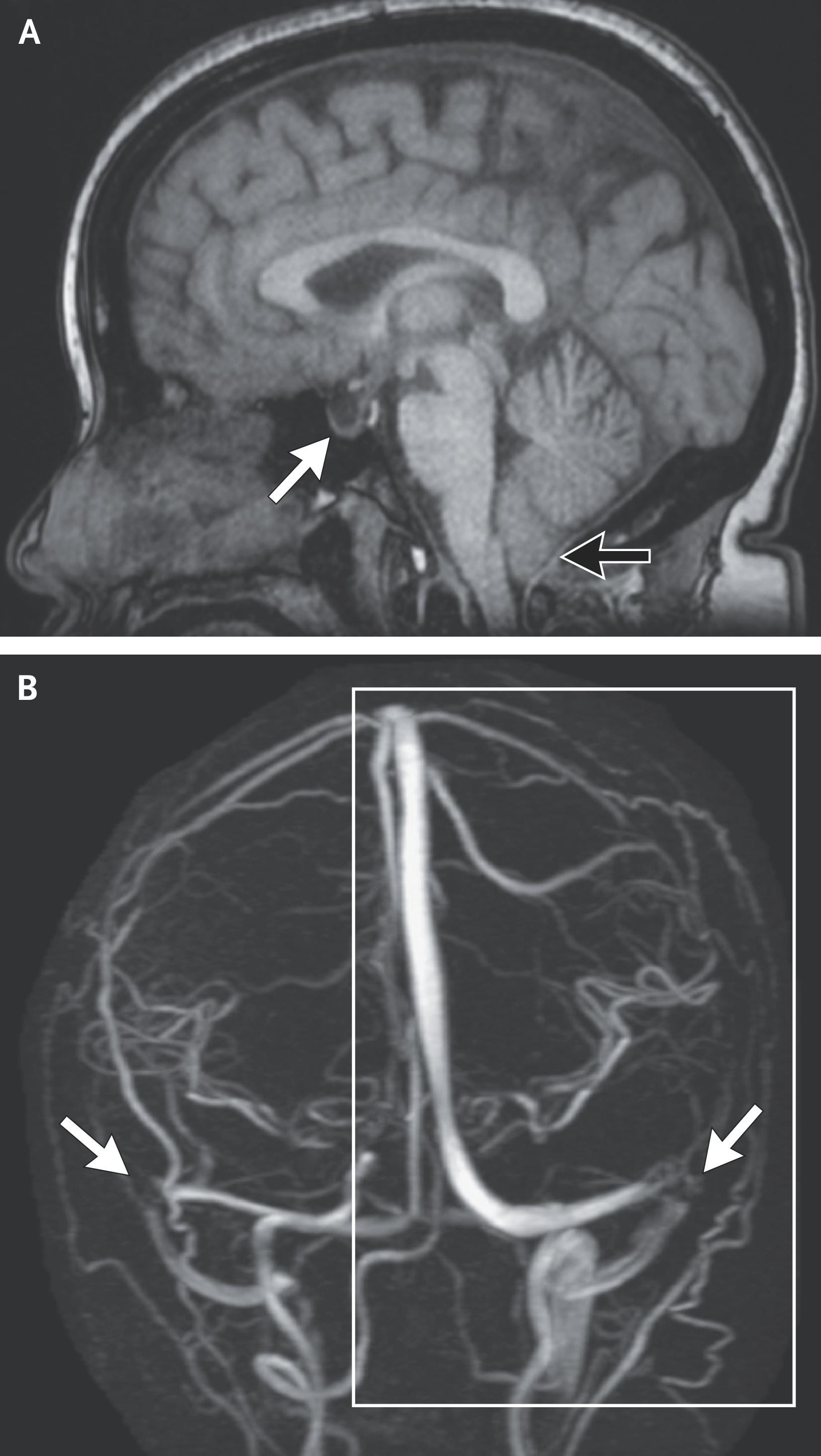 MRI Scans in Idiopathic Intracranial Hypertension.