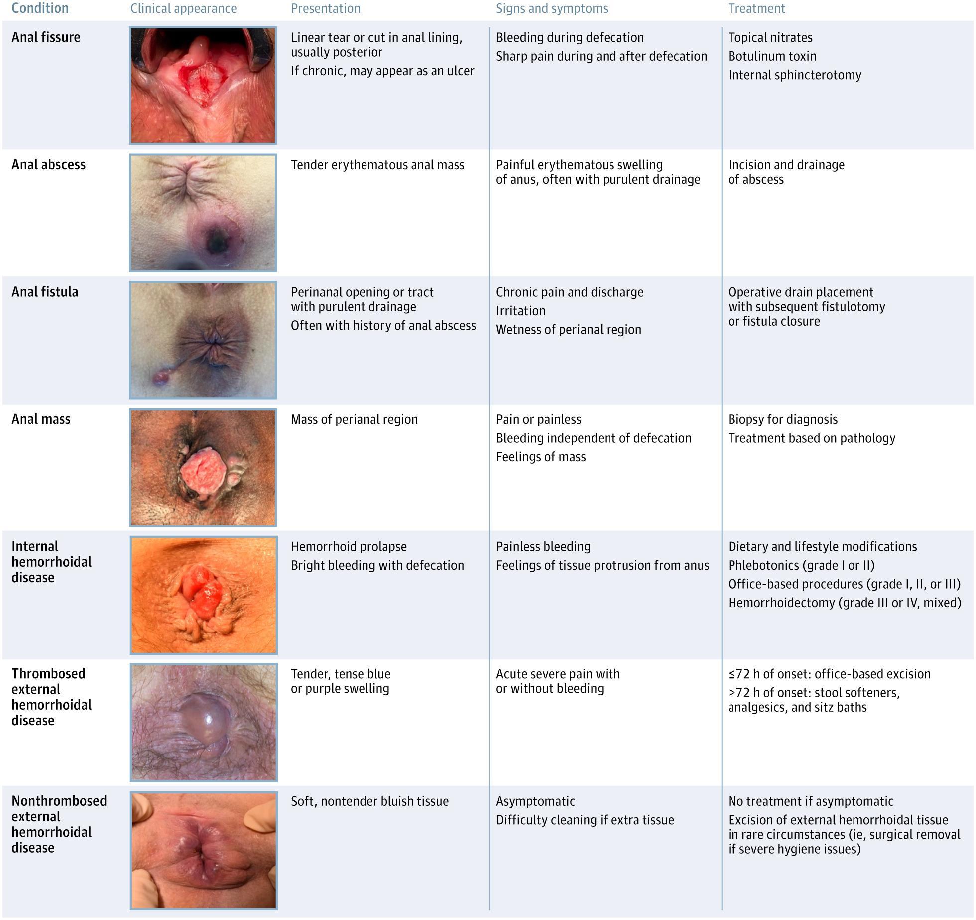 Conditions Commonly Mistaken for Hemorrhoidal Disease
