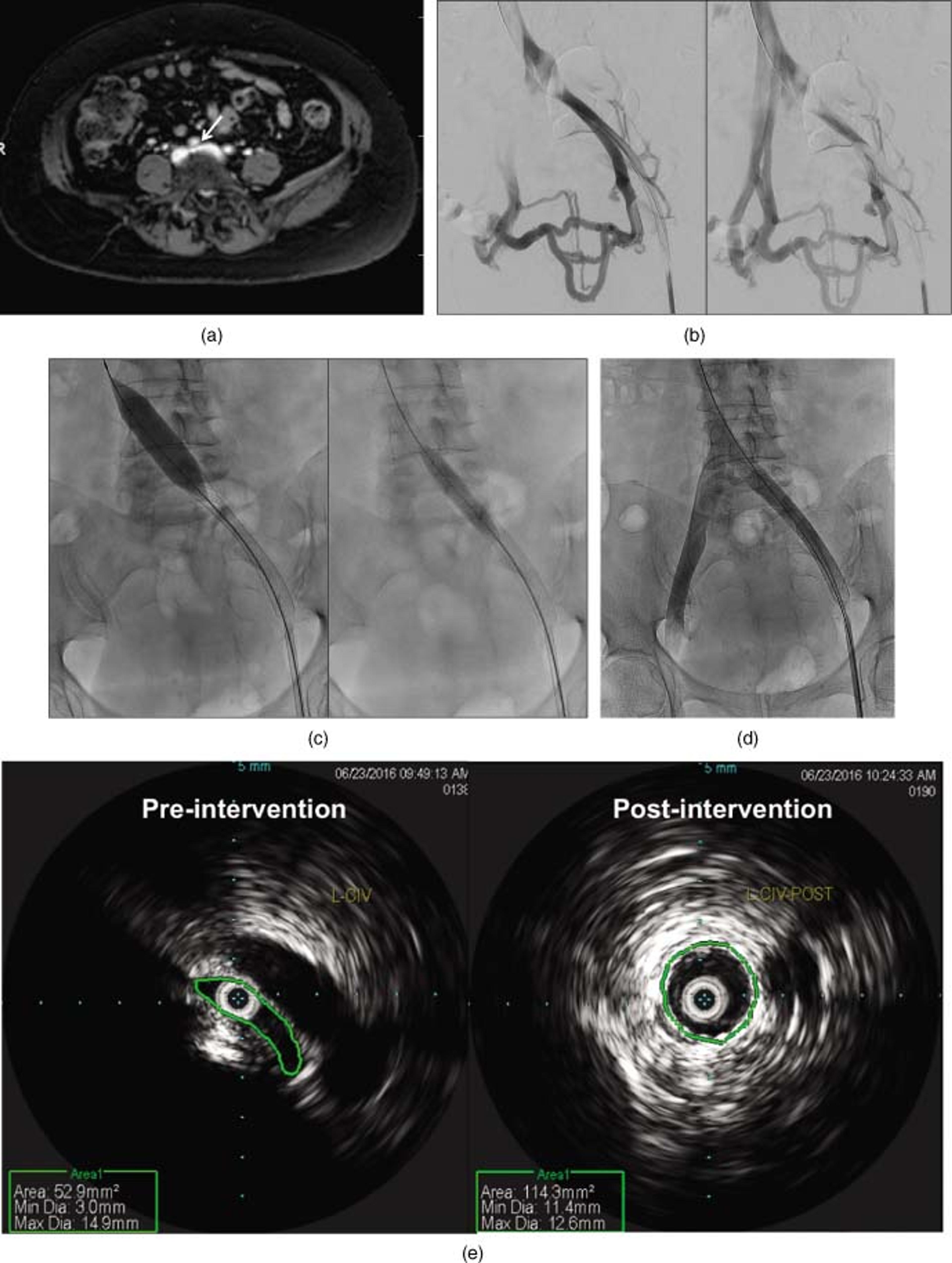 (a) MR venography showing the right common iliac artery compressing the left common iliac vein (arrow). (b) Venogram showing patency distal to the focal compression of the left common iliac vein. Retrograde flow is seen through the left hypogastric vein, which supplies multiple left‐to‐right pelvic collaterals that eventually drain into the IVC. (c) The left common iliac vein and left external iliac vein stenosis were stented using a 16 mm × 90 mm Wallstent. The Wallstent was then post dilated proximally to 16 mm and distally to 12 mm. (d) Post‐intervention venogram showing marked improvement in the diameter of the lumen and resolution of the collateral veins previously seen. (e) Marked improvement in luminal area of the left common iliac vein by IVUS (53 mm 2 pre‐intervention to 114.3 mm 2 post‐intervention).