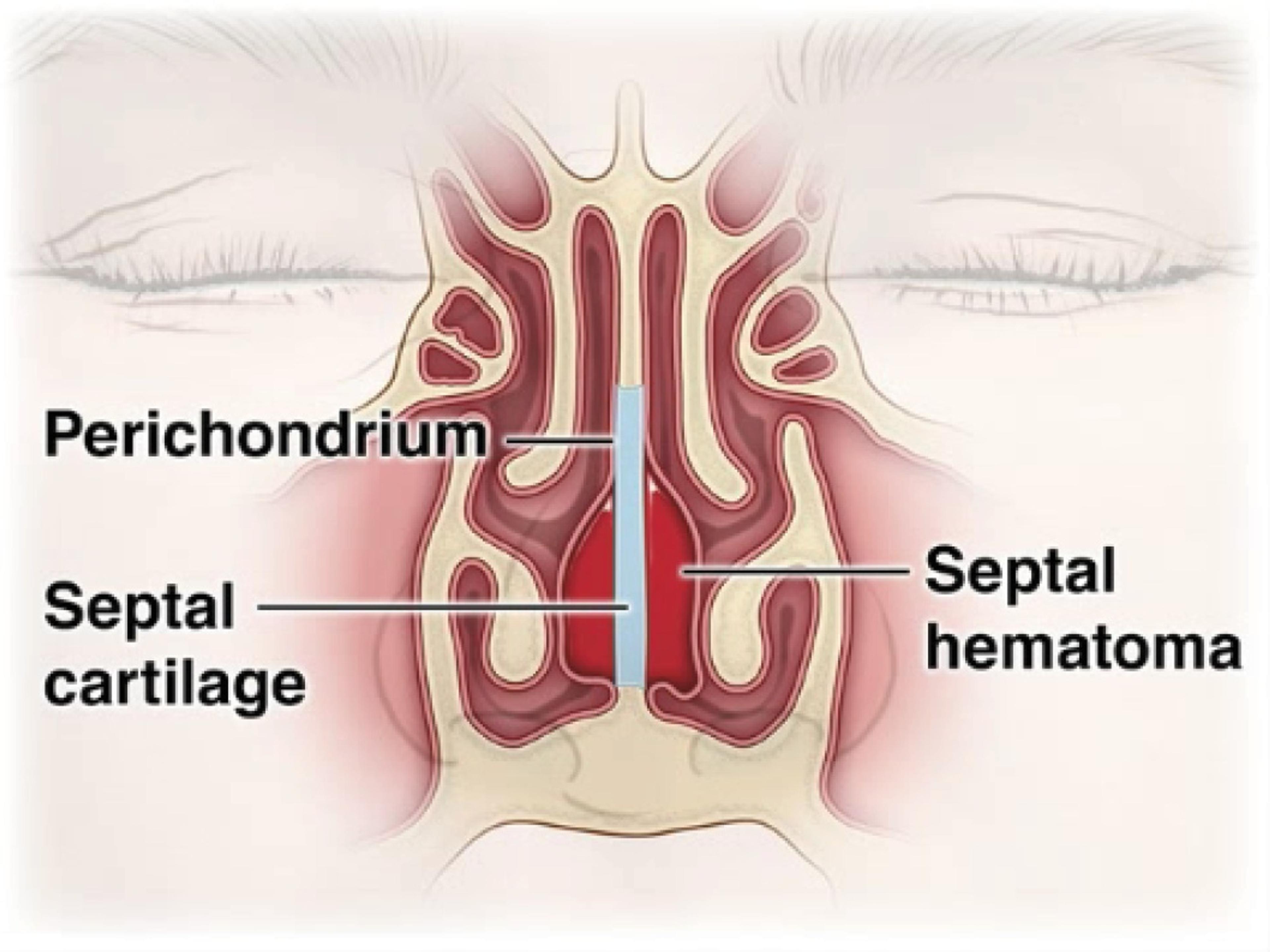 Coronal Cross Section of the Cartilaginous Portion of the Nasal Septum.