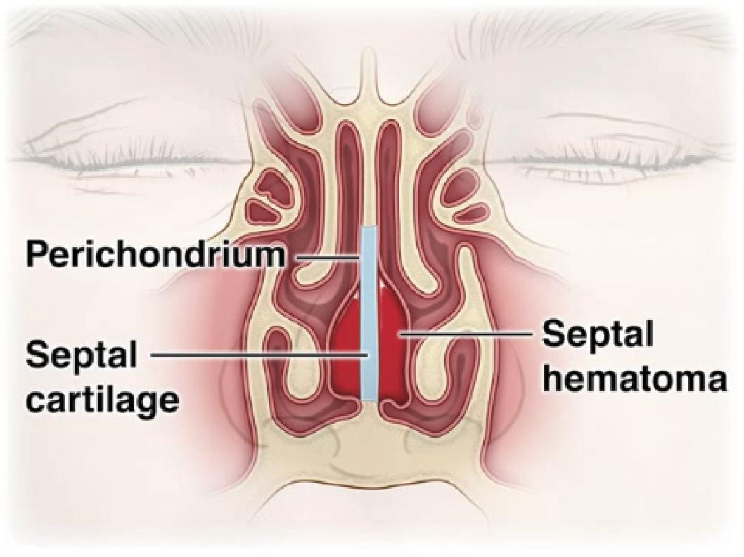 Coronal Cross Section of the Cartilaginous Portion of the Nasal Septum.