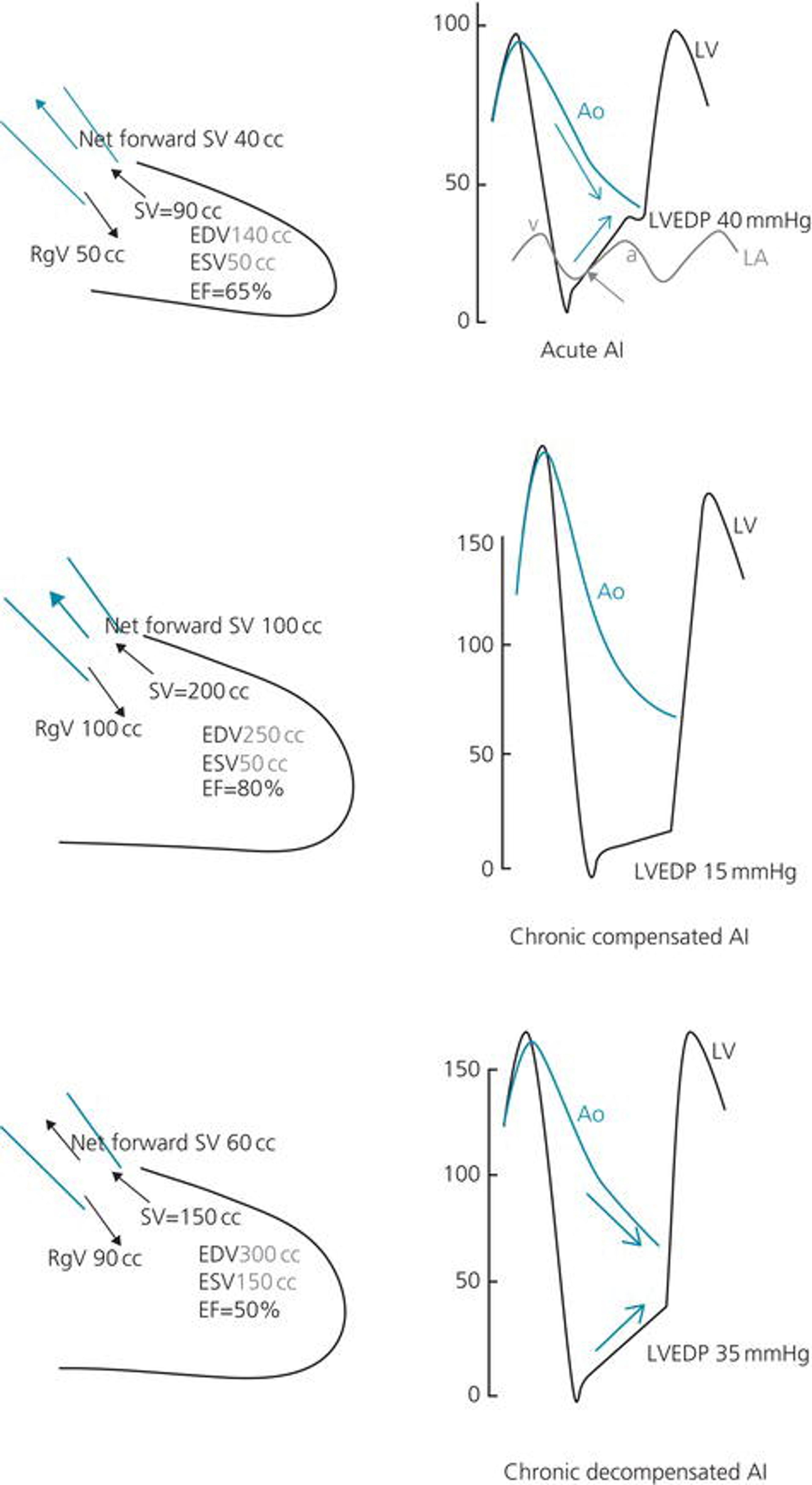 1.  In acute AI, LV volume is normal and the regurgitant volume leads to a severe increase in LVEDP. The LV and aortic pressures approximate in end‐diastole forming a diastolic triangle ( blue arrows ) (∆<30 mmHg or <25% of SBP). LV diastolic pressure exceeds LA pressure in mid or late diastole ( gray arrow ).  2.  In chronic AI, LV volume increases and the total stroke volume increases, thus leading to a high pulse pressure, and the forward stroke volume is maintained. The LV is large and compliant in a way that it accommodates the regurgitant volume without an increase in LVEDP.  3.  In chronic decompensated AI, the LV function starts to be impaired, EF is reduced in a way that the forward stroke volume is reduced, and the LV volume increases, leading to increased LVEDP. Total stroke volume remains elevated, and thus, the pulse pressure remains elevated. Note the attenuation or loss of the dicrotic notch, especially in acute AI . In chronic AI, the aorta may improve its compliance, causing the dicrotic notch to re‐emerge. EDV, end‐diastolic volume; EF, ejection fraction; ESV, end‐systolic volume; RgV, regurgitant volume; SV, stroke volume. Reproduced with permission from Hanna EB. Aortic regurgitation. In: Hanna EB, Glancy DL. Practical Cardiovascular Hemodynamics. New York, NY: Demos Medical, 2012, p. 115.