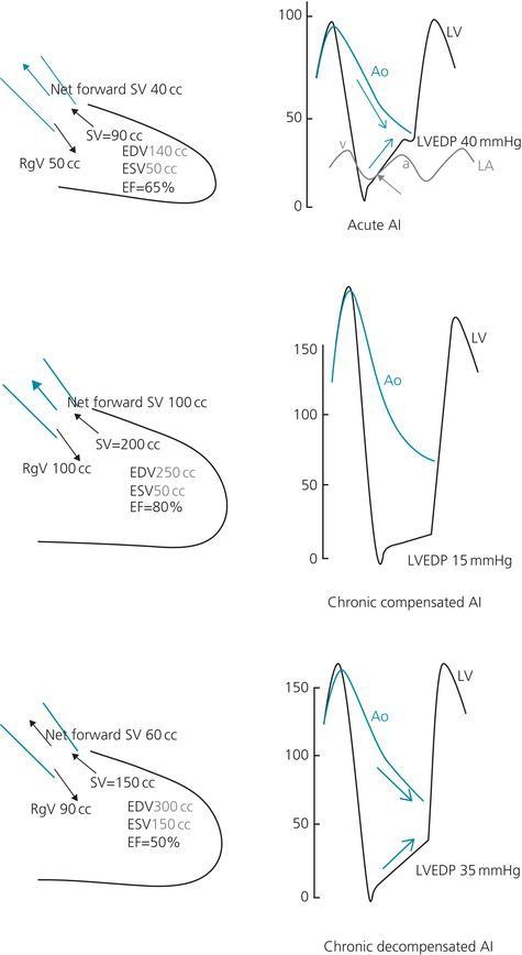 1. In acute AI, LV volume is normal and the regurgitant volume leads to a severe increase in LVEDP. The LV and aortic pressures approximate in end‐diastole forming a diastolic triangle ( blue arrows ) (∆<30 mmHg or <25% of SBP). LV diastolic pressure exceeds LA pressure in mid or late diastole ( gray arrow ). 2. In chronic AI, LV volume increases and the total stroke volume increases, thus leading to a high pulse pressure, and the forward stroke volume is maintained. The LV is large and compliant in a way that it accommodates the regurgitant volume without an increase in LVEDP. 3. In chronic decompensated AI, the LV function starts to be impaired, EF is reduced in a way that the forward stroke volume is reduced, and the LV volume increases, leading to increased LVEDP. Total stroke volume remains elevated, and thus, the pulse pressure remains elevated. Note the attenuation or loss of the dicrotic notch, especially in acute AI . In chronic AI, the aorta may improve its compliance, causing the dicrotic notch to re‐emerge. EDV, end‐diastolic volume; EF, ejection fraction; ESV, end‐systolic volume; RgV, regurgitant volume; SV, stroke volume. Reproduced with permission from Hanna EB. Aortic regurgitation. In: Hanna EB, Glancy DL. Practical Cardiovascular Hemodynamics. New York, NY: Demos Medical, 2012, p. 115.