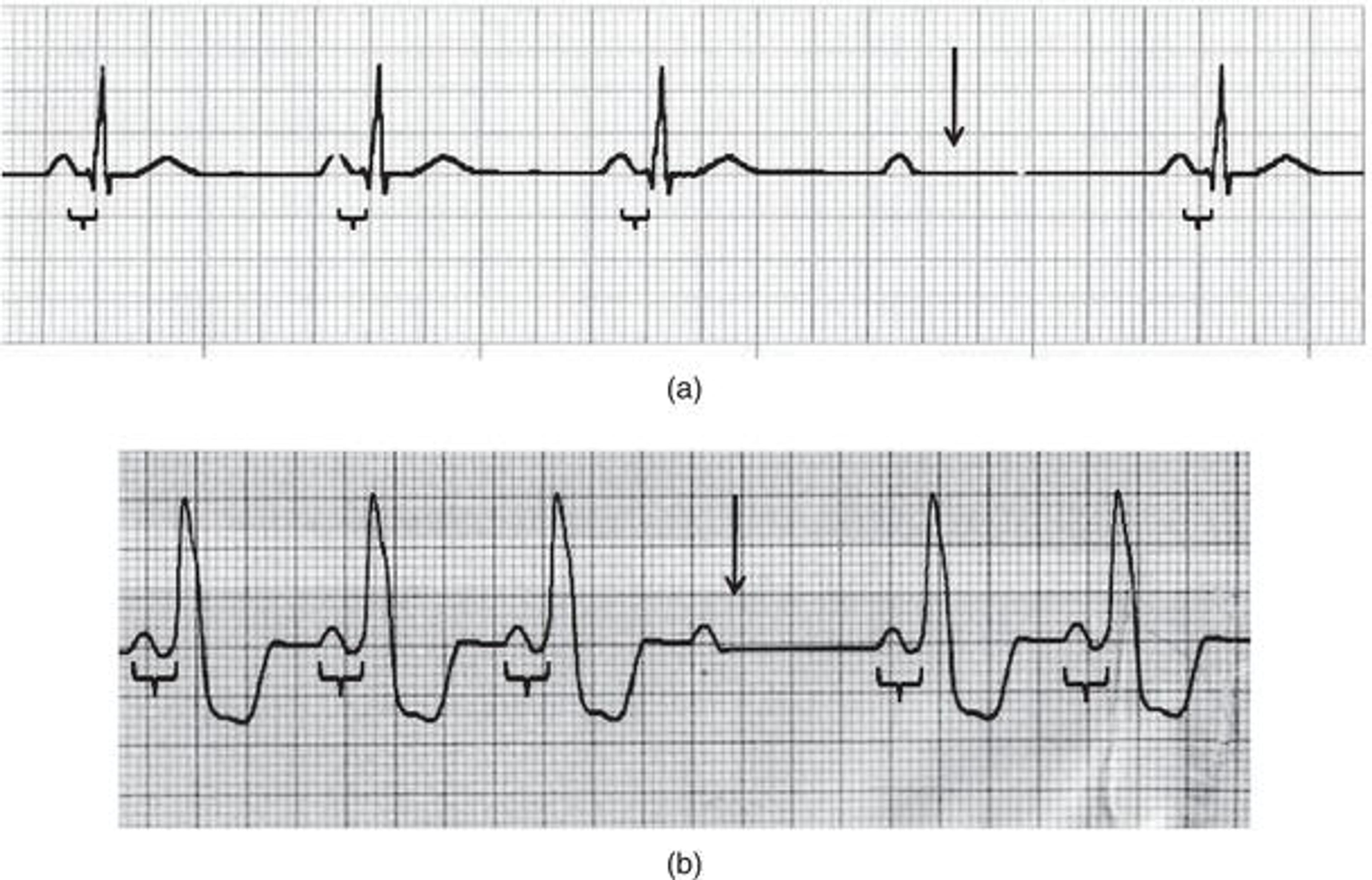 Second‐degree type II AV block type (Mobitz II). Note the consistent PR interval (braces) followed by an orphan P wave and resultant dropped QRS complex (arrow). (a) Narrow QRS complex; (b) wide QRS complex.