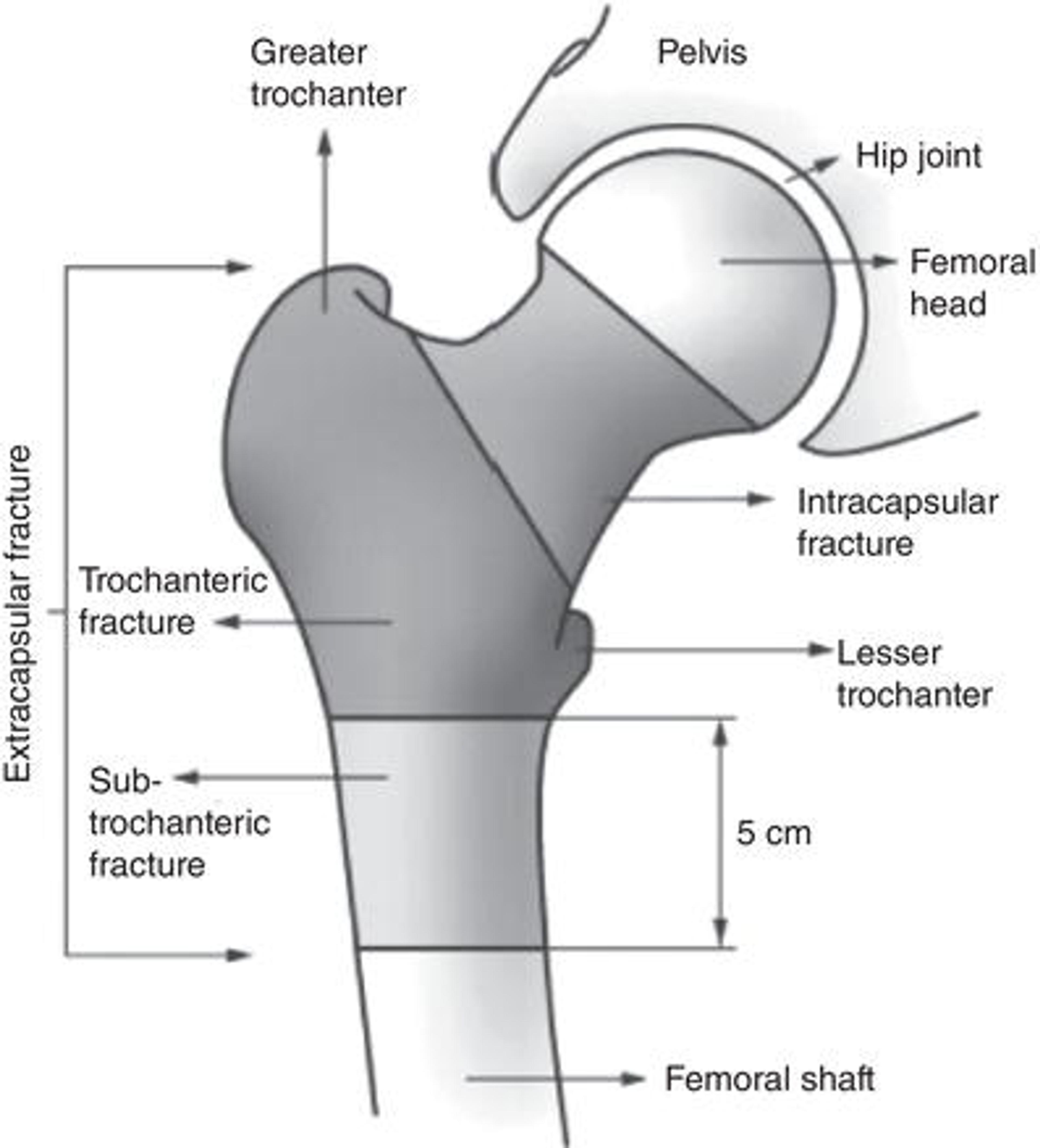 Classification of hip fractures by Parker and Johansen. Source: Parker and Johansen , © 2006 BMJ Publishing Group Ltd.
