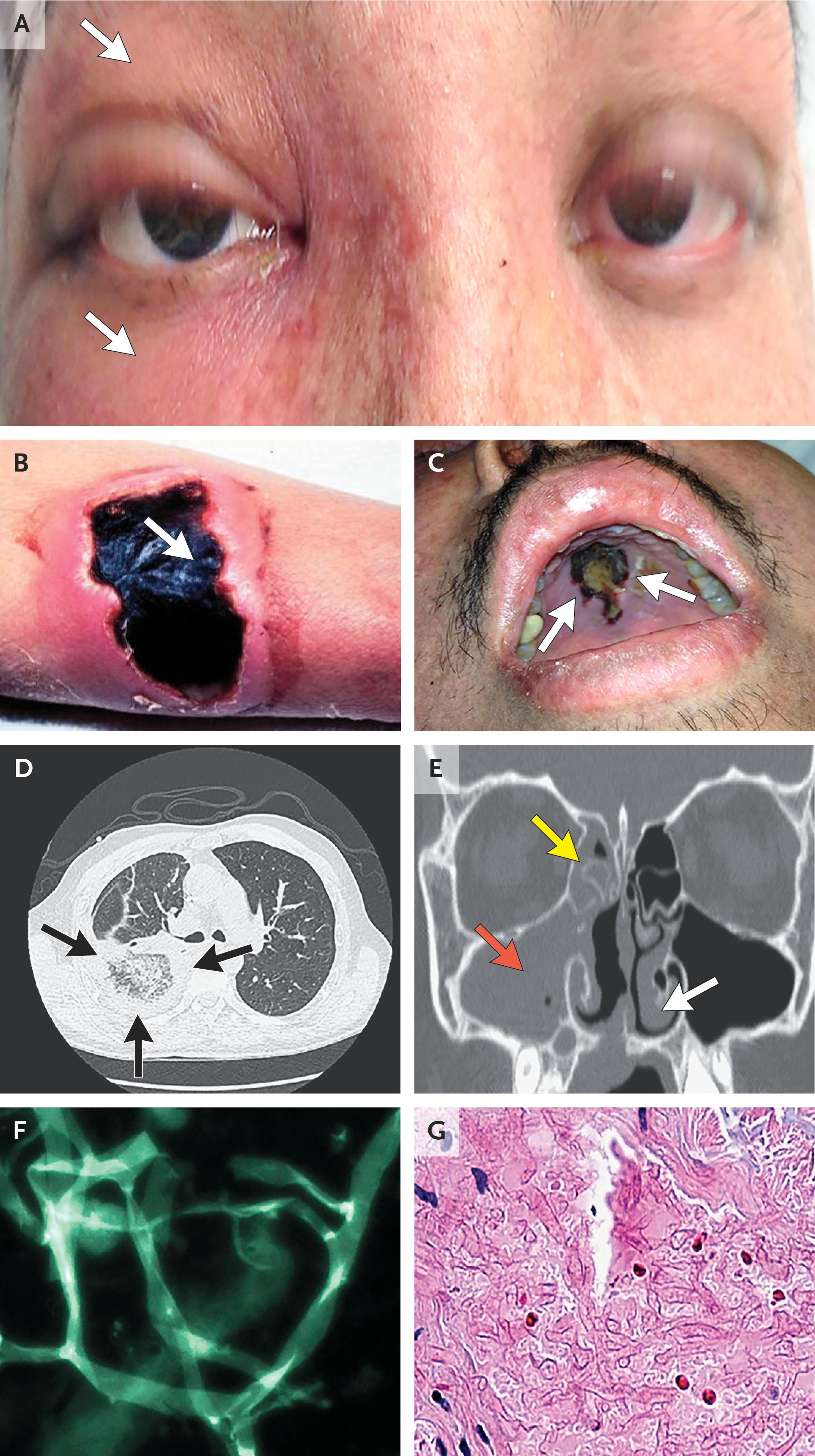 Direct Examination and CT Imaging in Mucormycosis.