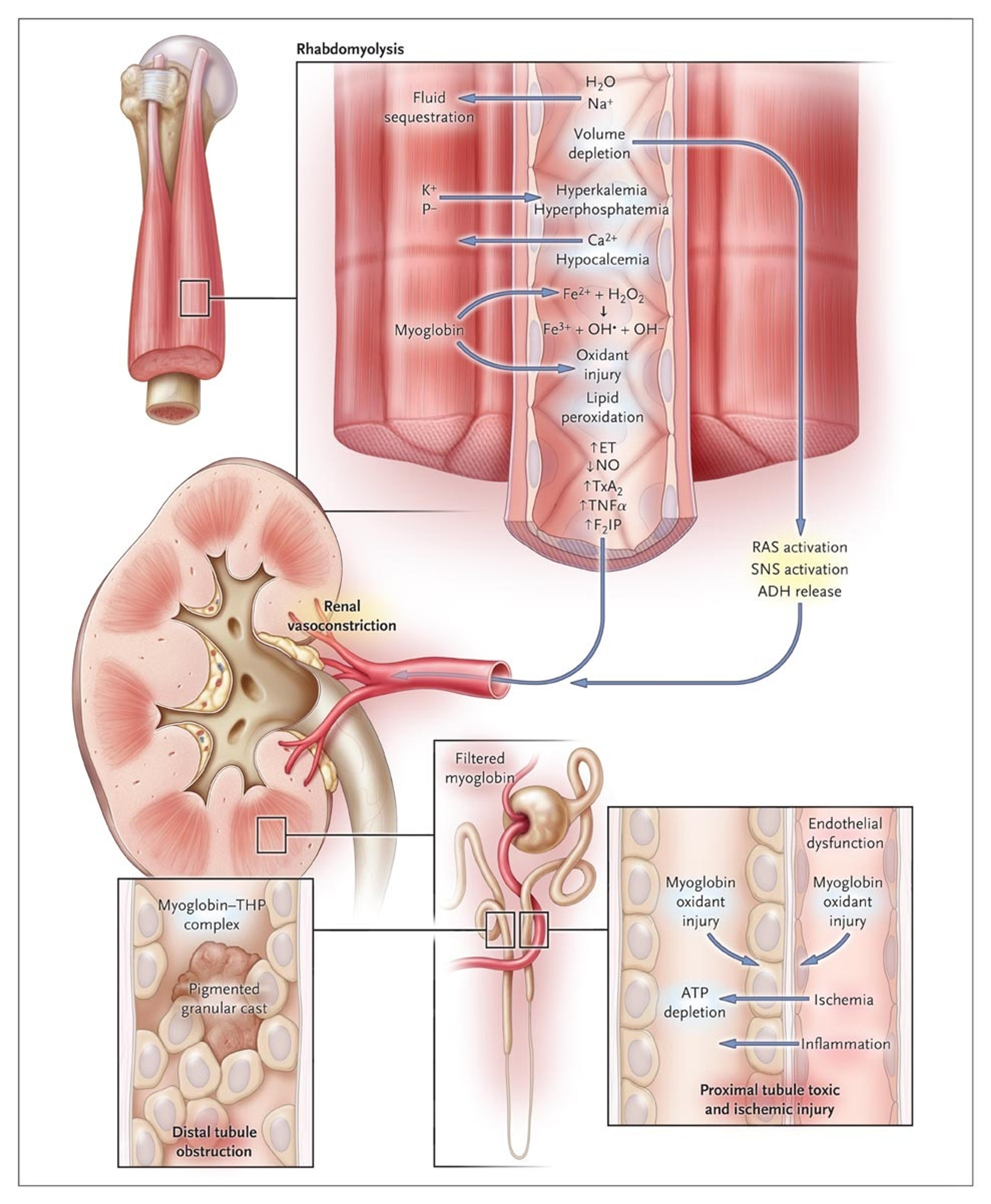 Pathophysiological Mechanisms in Rhabdomyolysis-Induced Acute Kidney Injury.