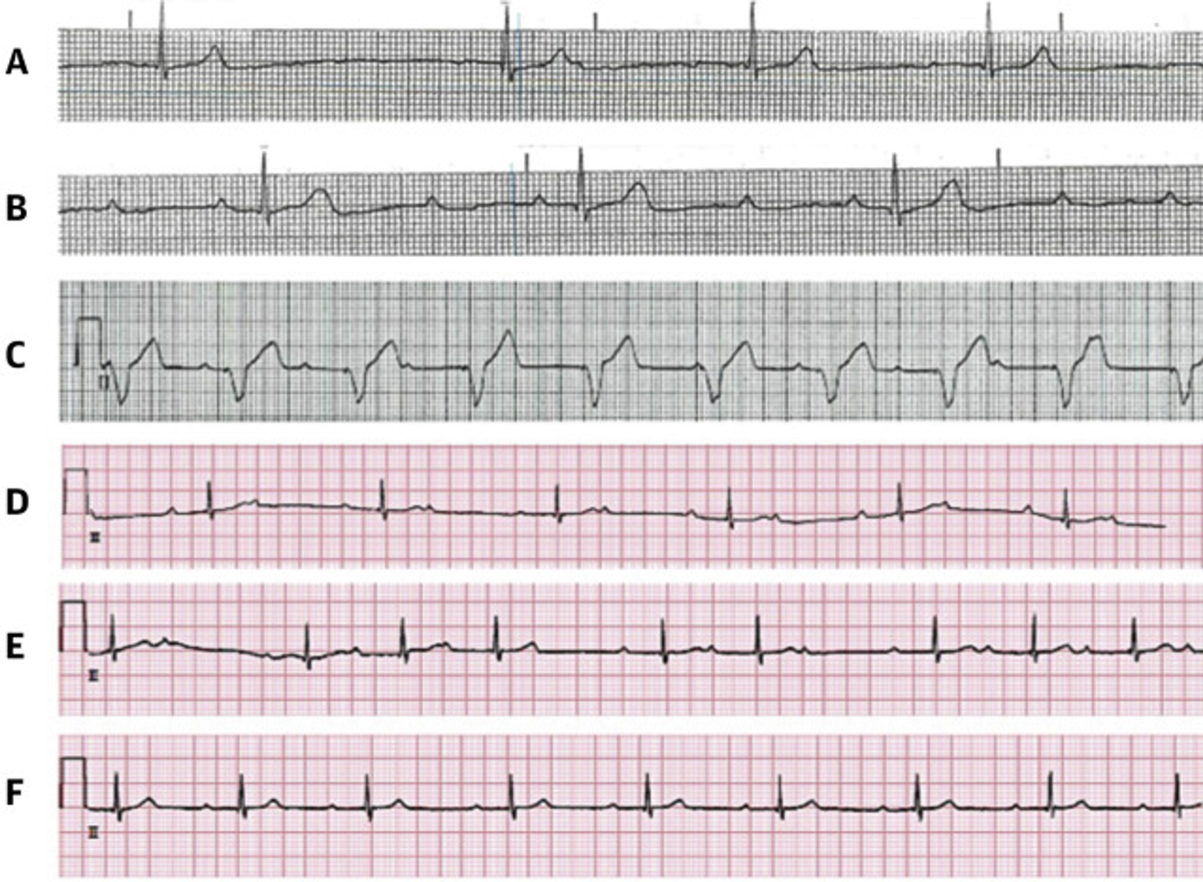 The Electrocardiographic Progression of a Patient With LC Presenting With High-Degree AVB