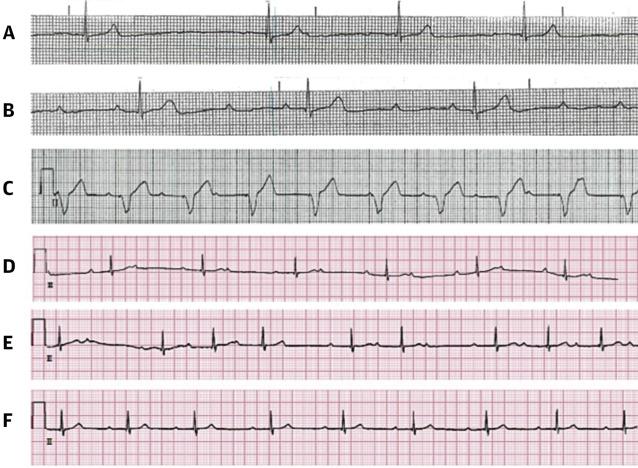 The Electrocardiographic Progression of a Patient With LC Presenting With High-Degree AVB