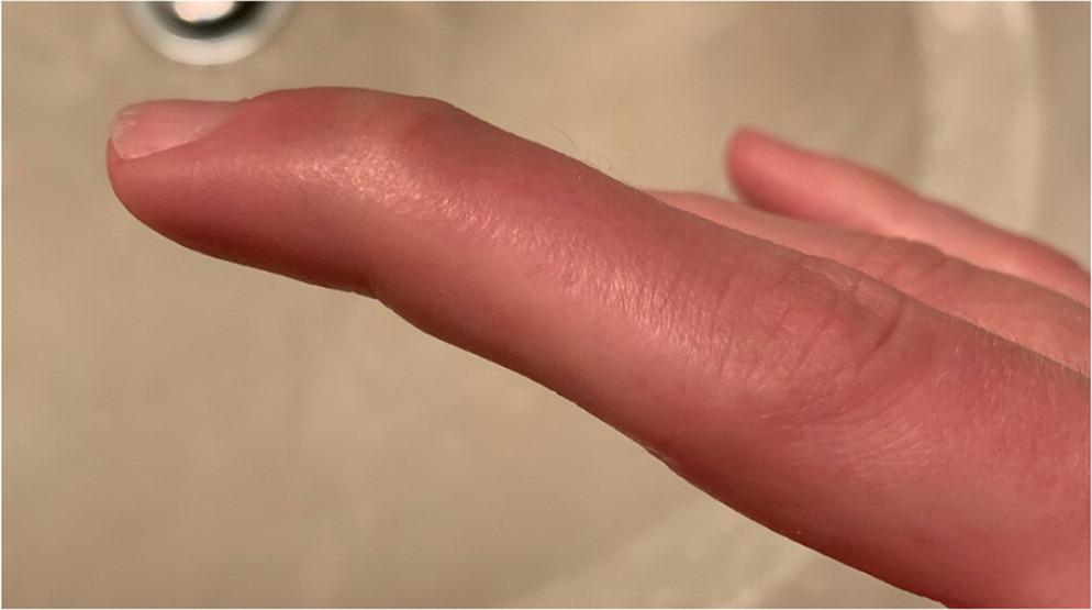 Acute mallet finger injury.