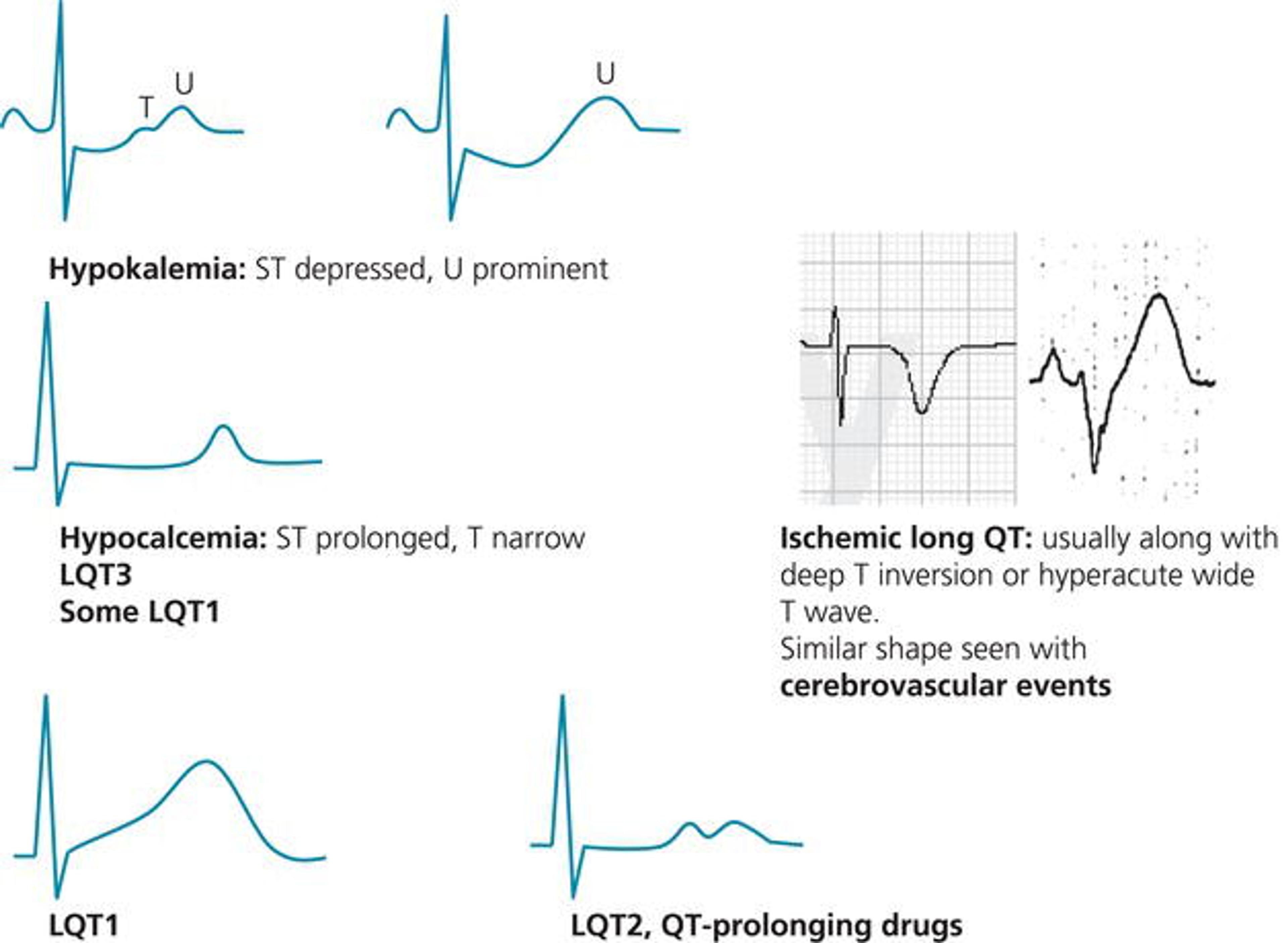 Typical ST–T morphologies in hypokalemia, hypocalcemia, congenital long QT syndromes, and ischemic QT prolongation. - In hypokalemia, the ST segment is depressed and U wave is large while T wave is flattened.
- In hypocalcemia and LQT3, QT interval is prolonged as a result of the ST‐segment prolongation. As opposed to other congenital long QT syndromes or QT prolongation secondary to drugs, T wave is not significantly widened.
- In LQT1, T wave is wide and ample without ST‐segment depression, but may also take the shape of LQT3. In LQT2 and in many drug‐induced long QT cases, T wave is wide and notched (double hump) and may simulate hypokalemia.