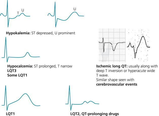 Typical ST–T morphologies in hypokalemia, hypocalcemia, congenital long QT syndromes, and ischemic QT prolongation. - In hypokalemia, the ST segment is depressed and U wave is large while T wave is flattened.
- In hypocalcemia and LQT3, QT interval is prolonged as a result of the ST‐segment prolongation. As opposed to other congenital long QT syndromes or QT prolongation secondary to drugs, T wave is not significantly widened.
- In LQT1, T wave is wide and ample without ST‐segment depression, but may also take the shape of LQT3. In LQT2 and in many drug‐induced long QT cases, T wave is wide and notched (double hump) and may simulate hypokalemia.