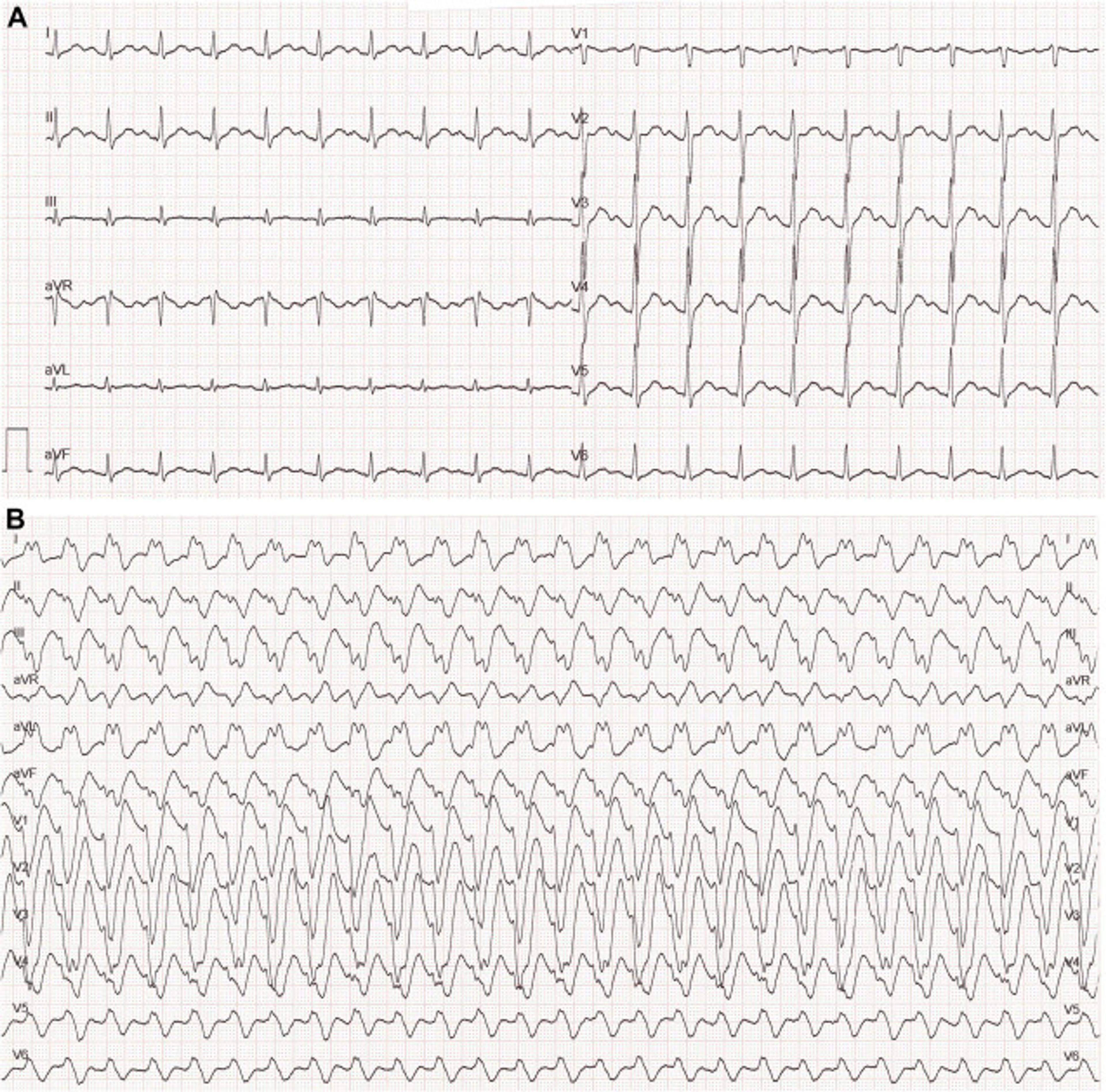 Electrophysiological Evolution of the Na+ Channel Blocking Effect Induced by Cocaine Intoxication