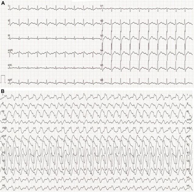 Electrophysiological Evolution of the Na+ Channel Blocking Effect Induced by Cocaine Intoxication