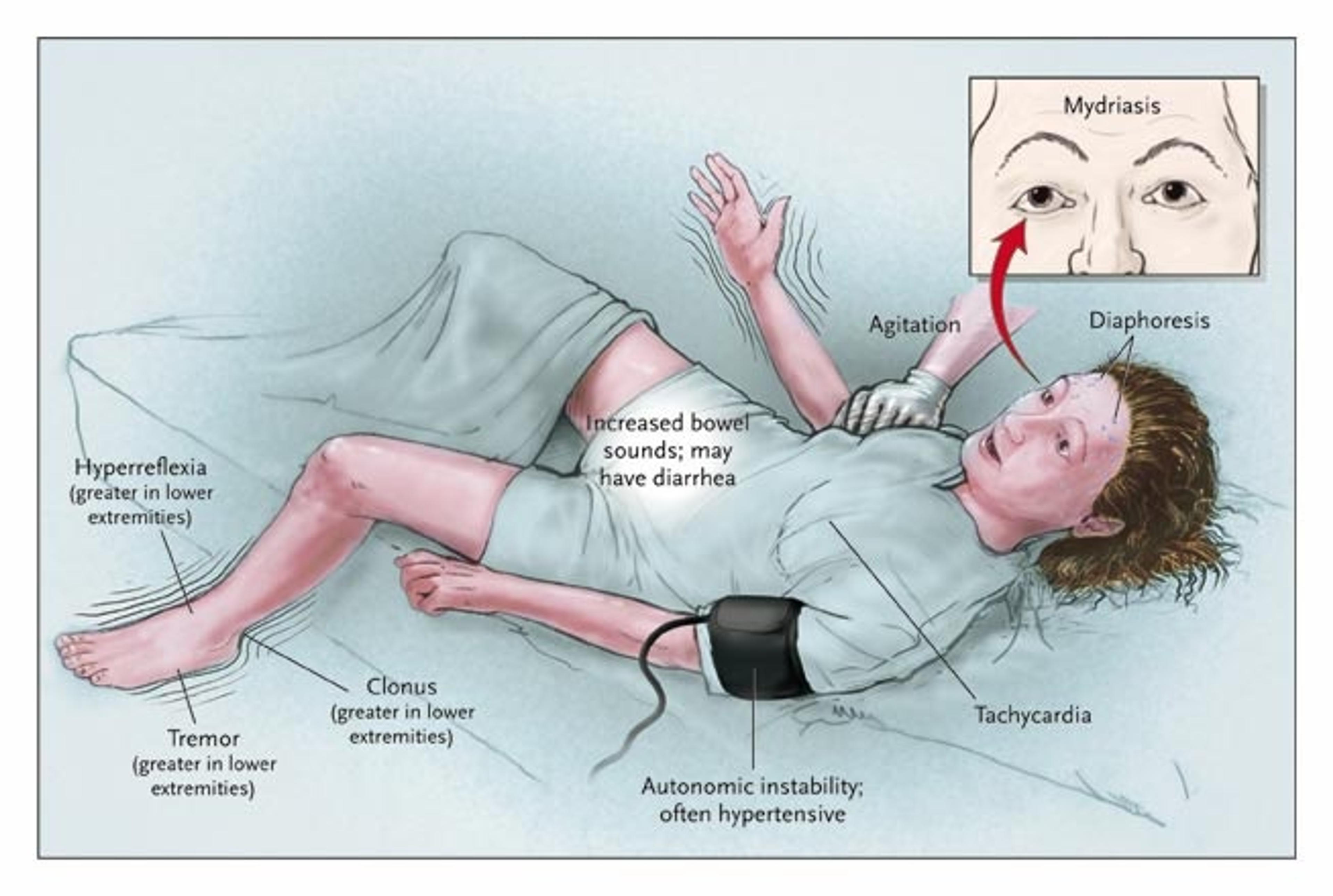 Findings in a Patient with Moderately Severe Serotonin Syndrome.
