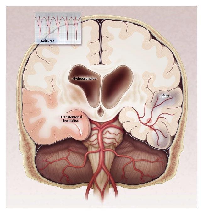 Major Intracranial Complications in Bacterial Meningitis in Adults.