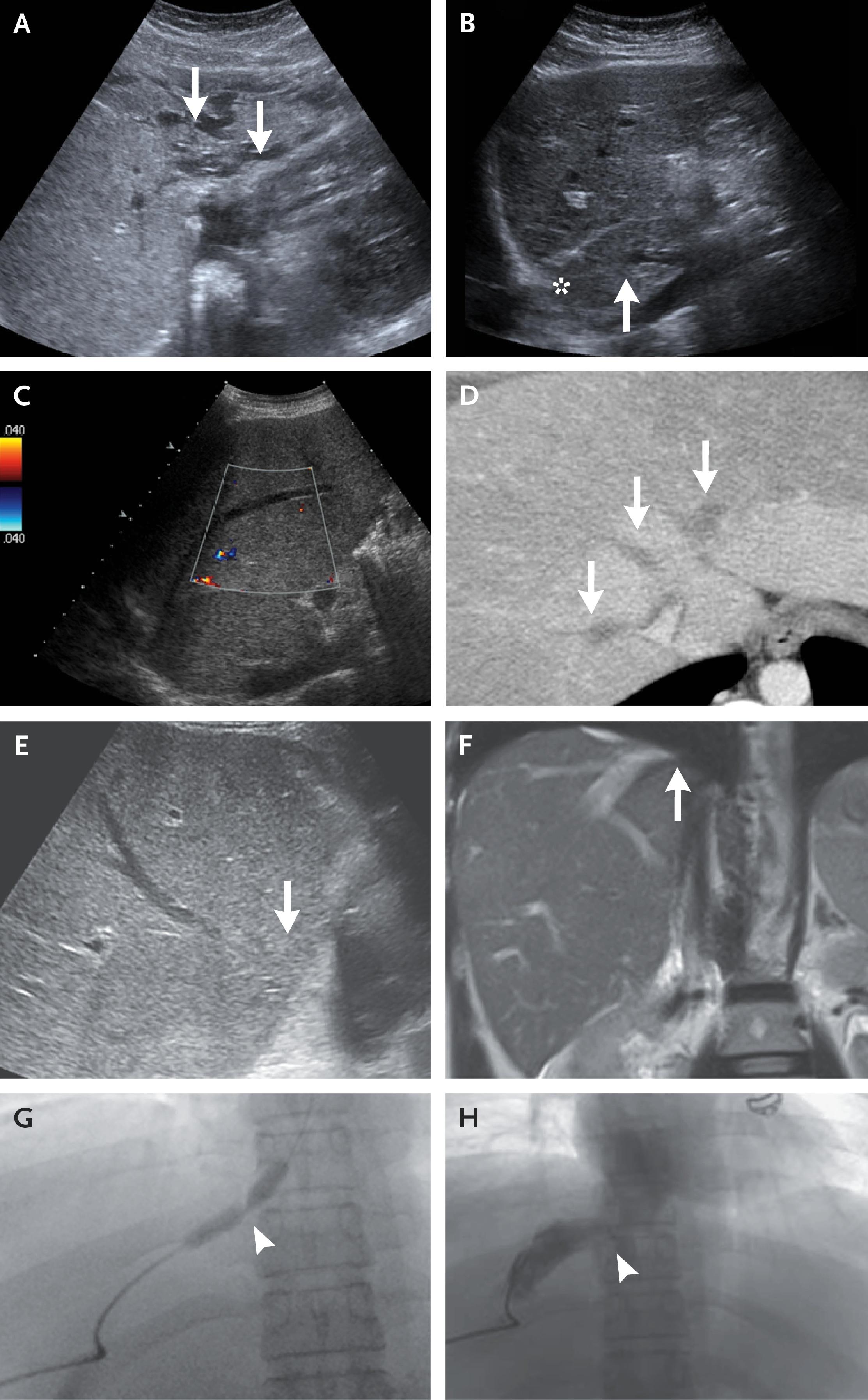 Imaging Features of Budd–Chiari Syndrome.