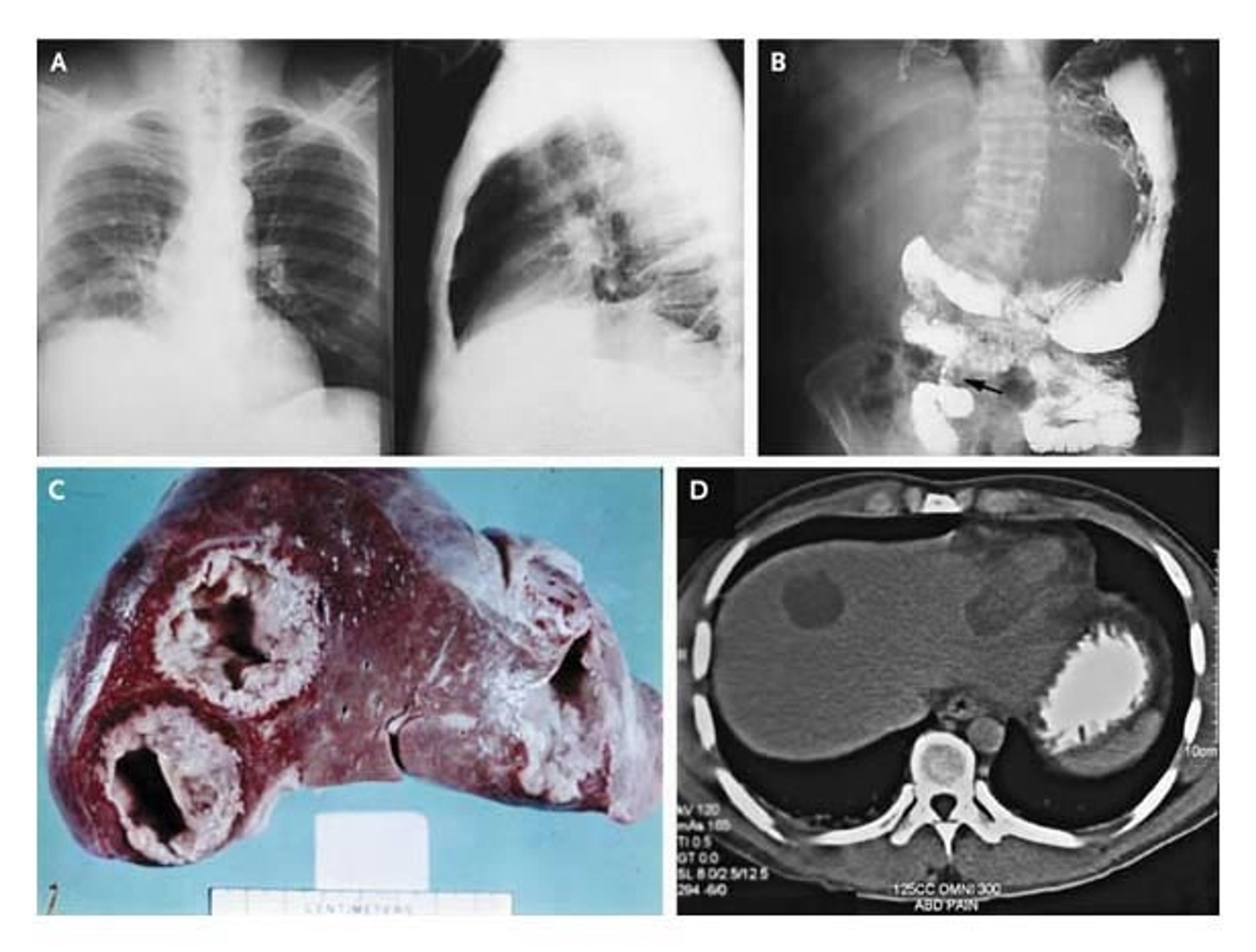 Radiographic and Pathological Features of Extraintestinal Amebiasis.