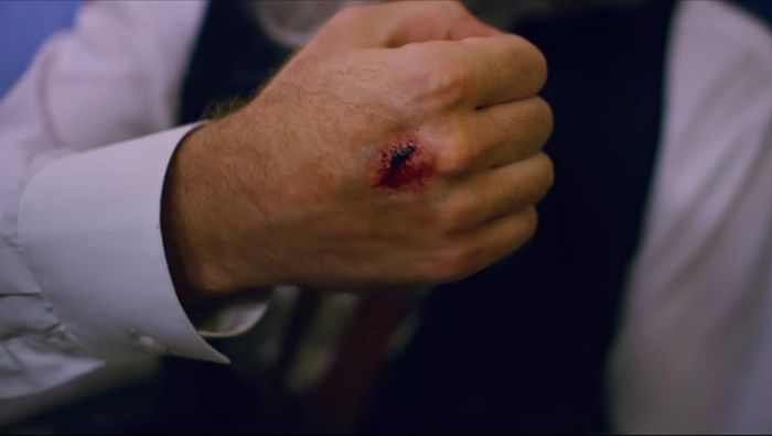 A rat bit me.