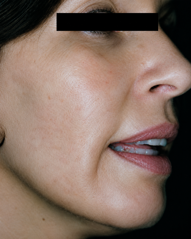 After: Sun-stressed and aged skin