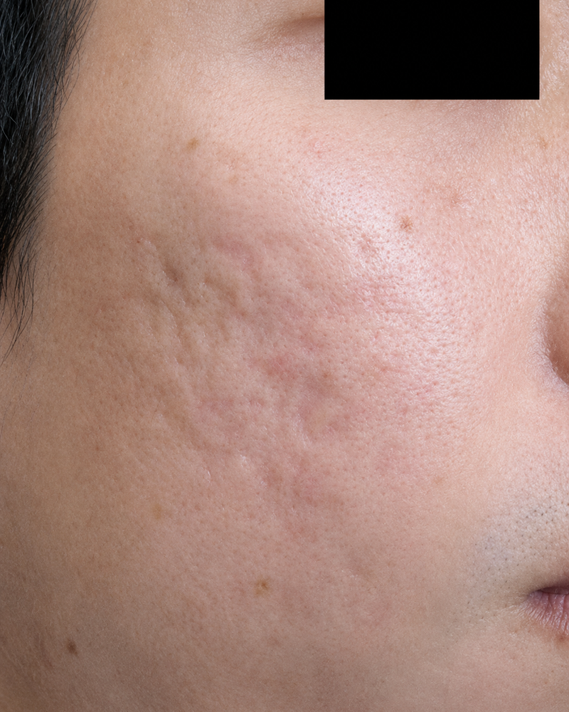 Before: Scarred skin