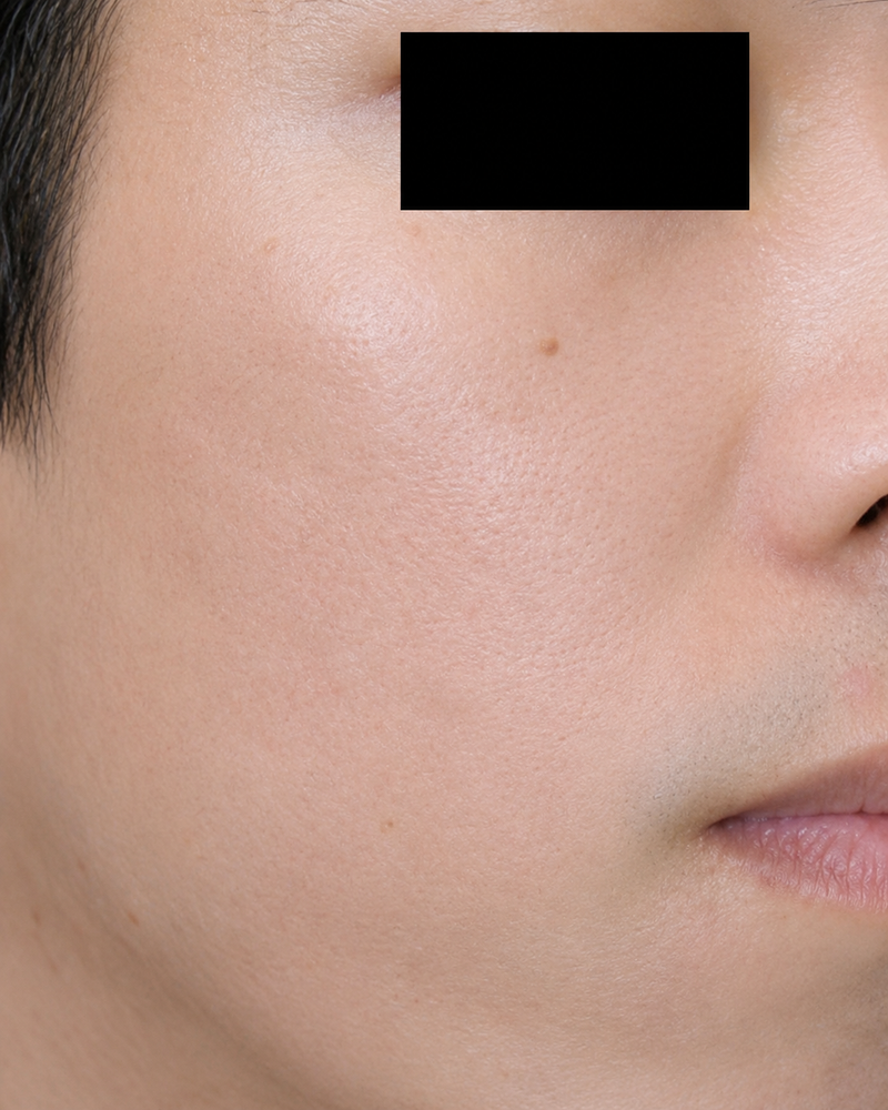 After: Scarred skin