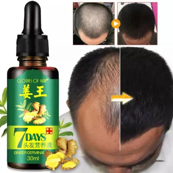 Ginger Germinal Oil For Hair Growth | 7 Days | Guaranteed Results | Fatest Hair Growth & Care | For Boys & Girls