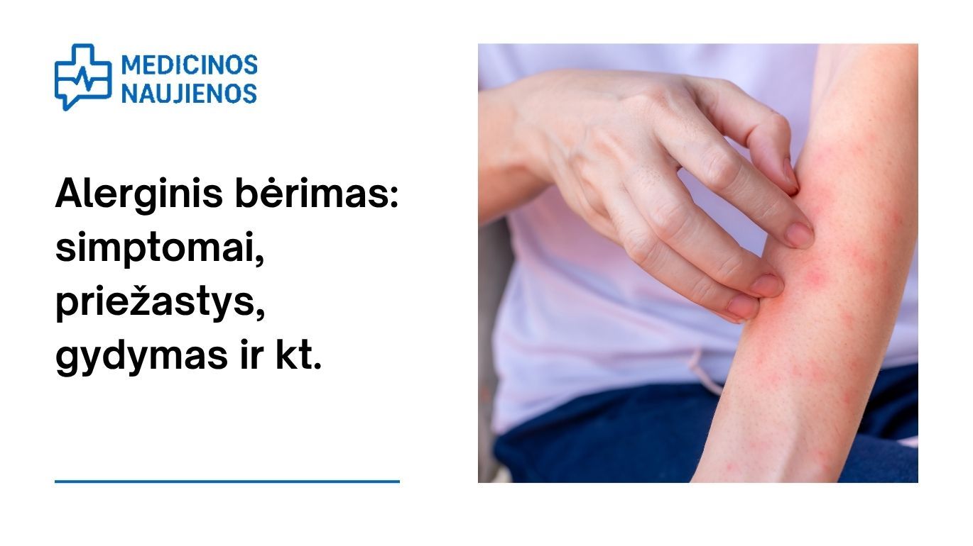 Alerginis bėrimas: simptomai, priežastys, gydymas ir kt.