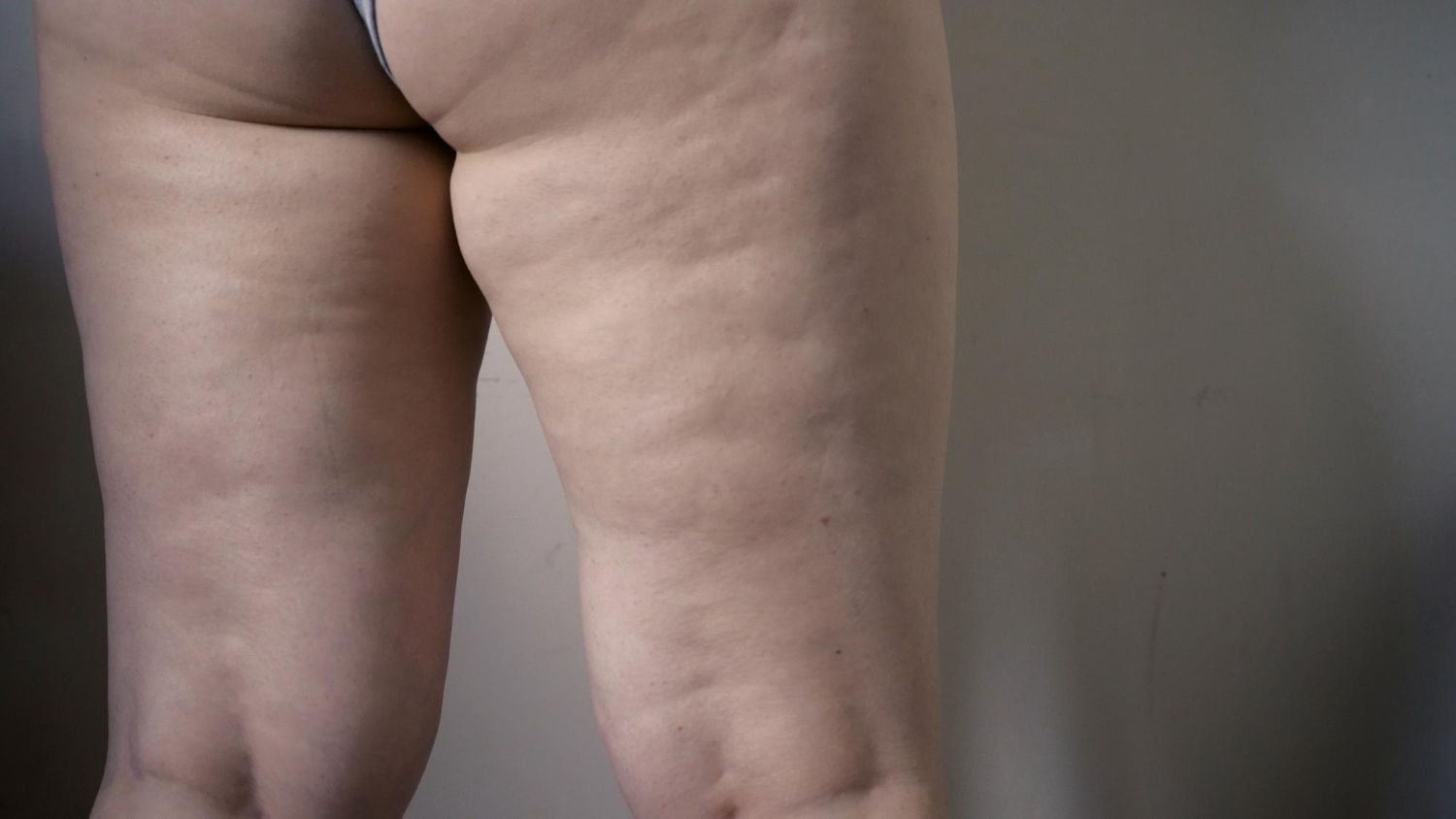Lipedema: Gydymas, simptomai, priežastys, prevencija