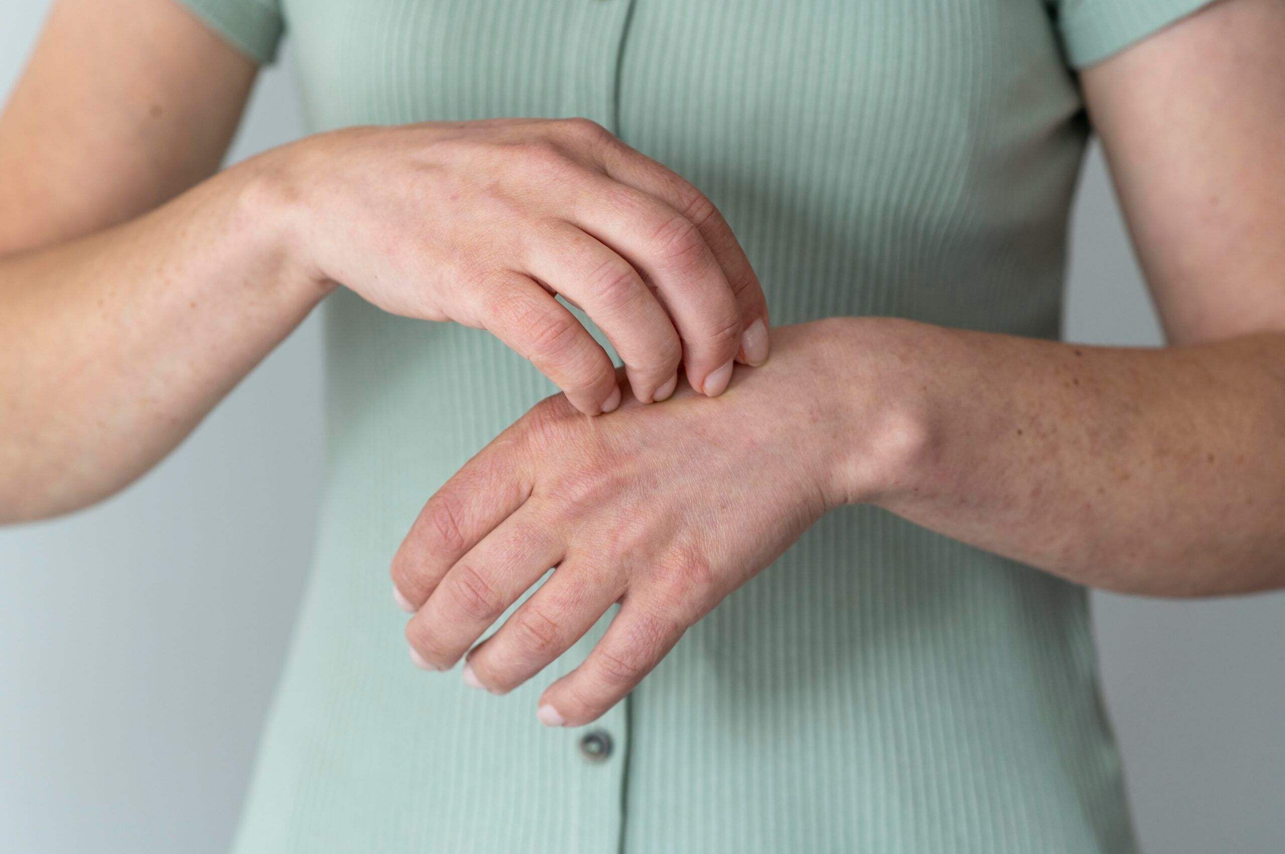 Diuringo pūslelinis dermatitas: Simptomai, priežastys, gydymas, prevencija