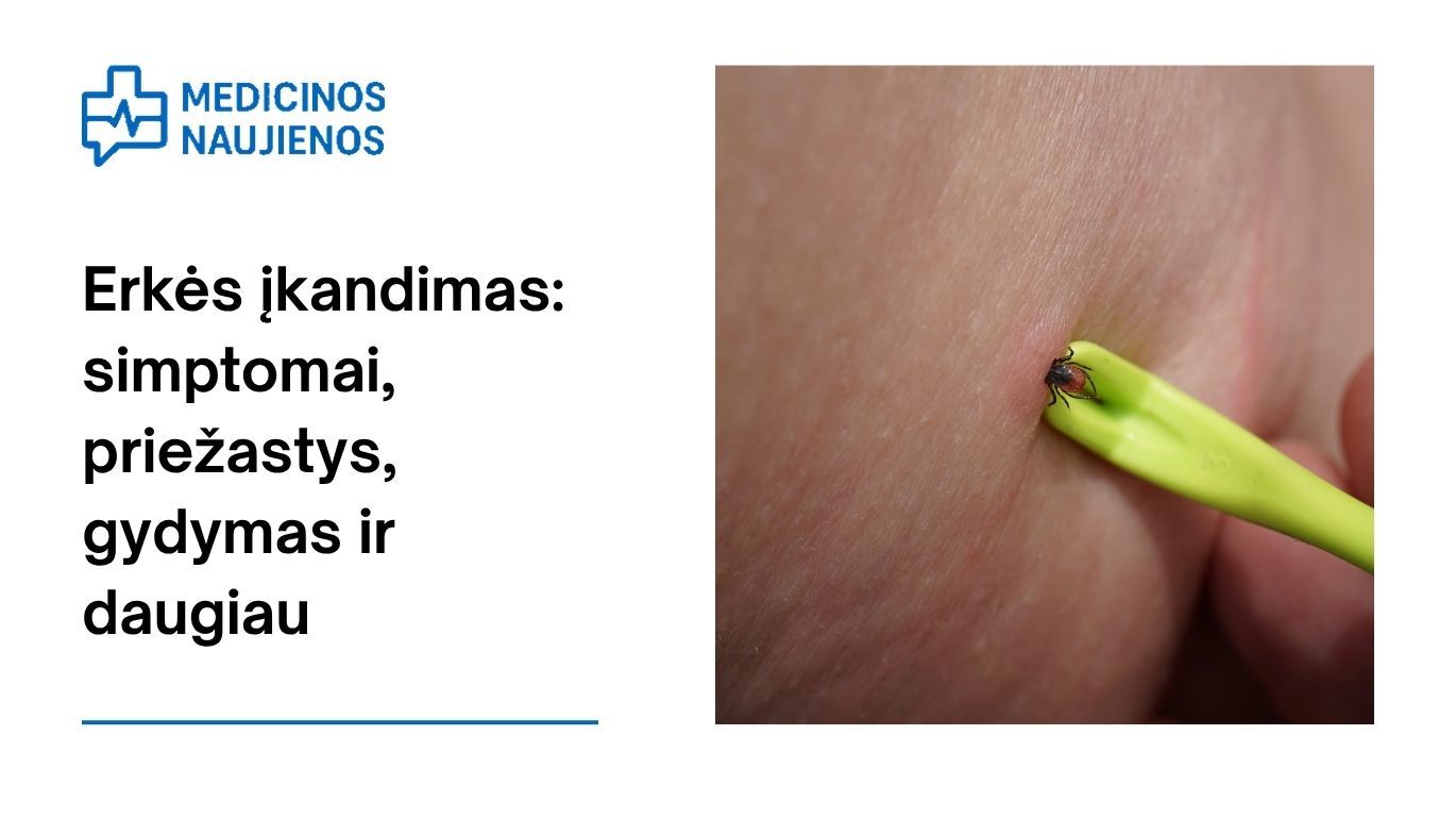 Erkės įkandimas: simptomai, priežastys, gydymas ir daugiau