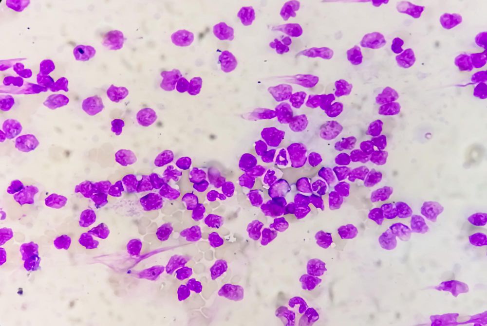 Ūminė mieloidinė leukemija: Simptomai, priežastys, gydymas, prevencija